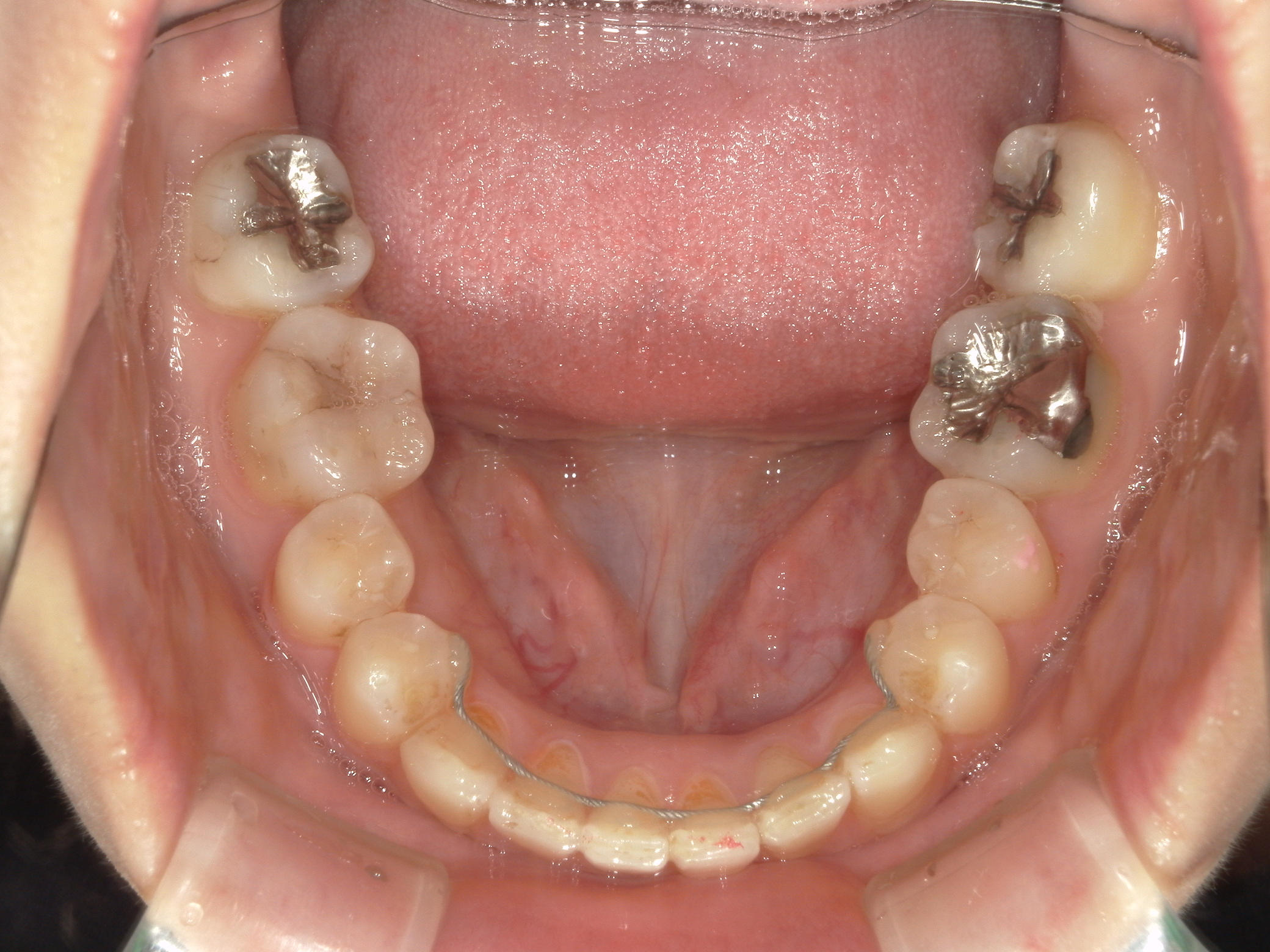 プチワイヤー矯正　症例（58）