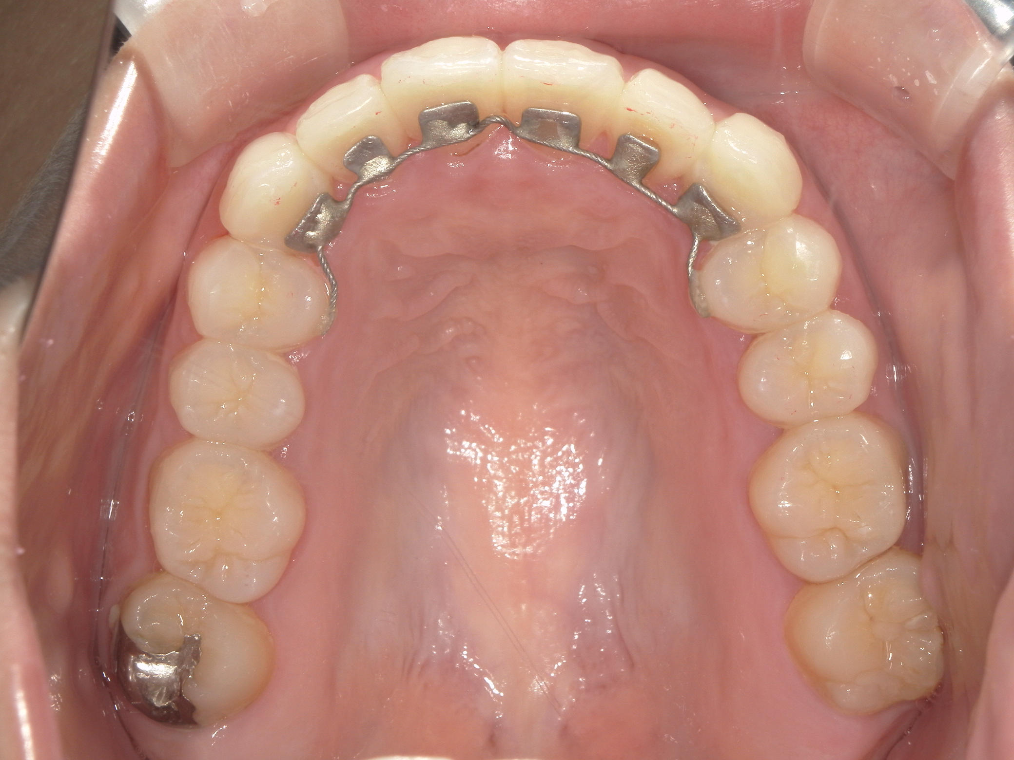 プチワイヤー矯正　症例（60）