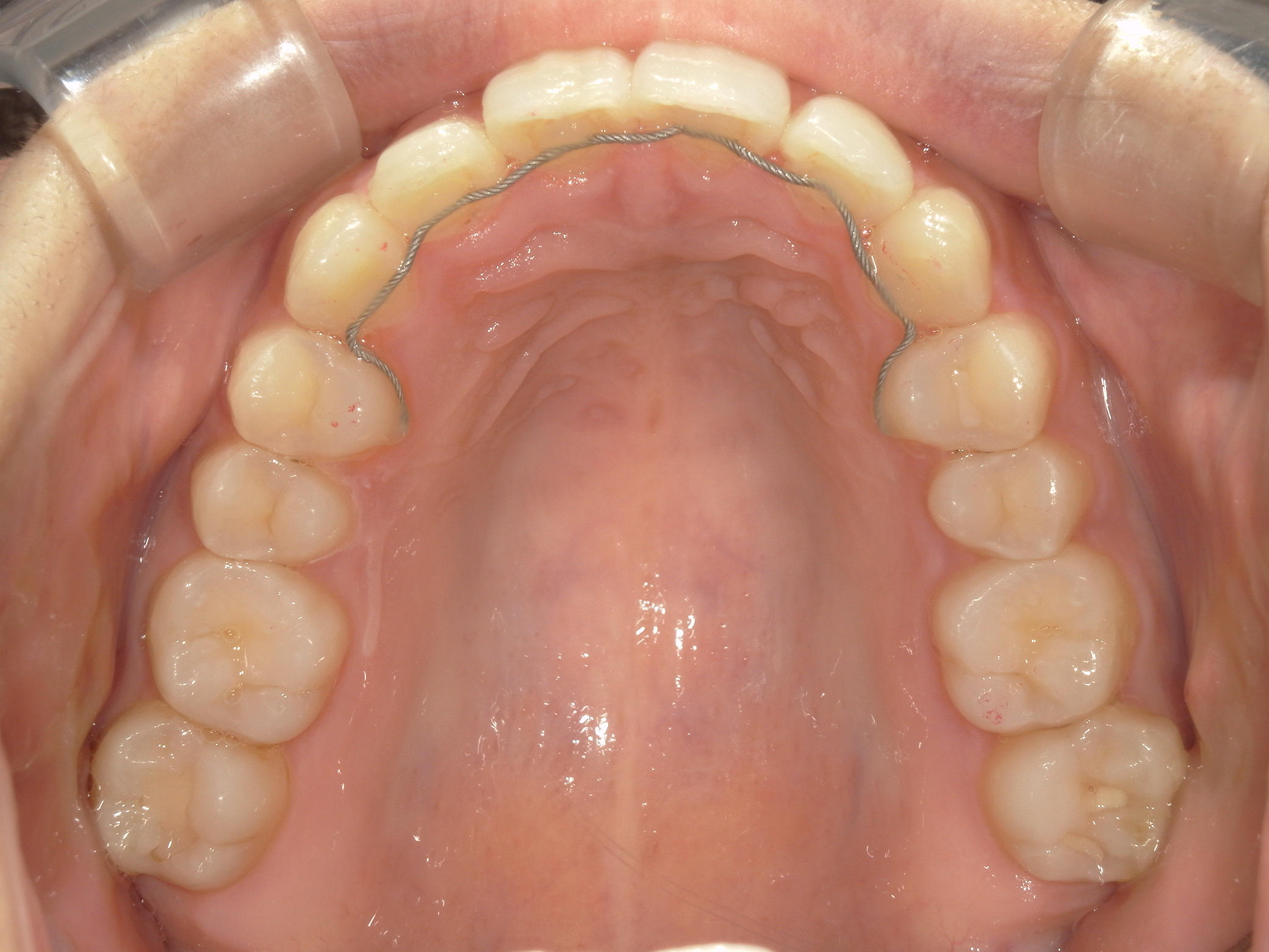 インビザライン(ライト)矯正　症例（31）