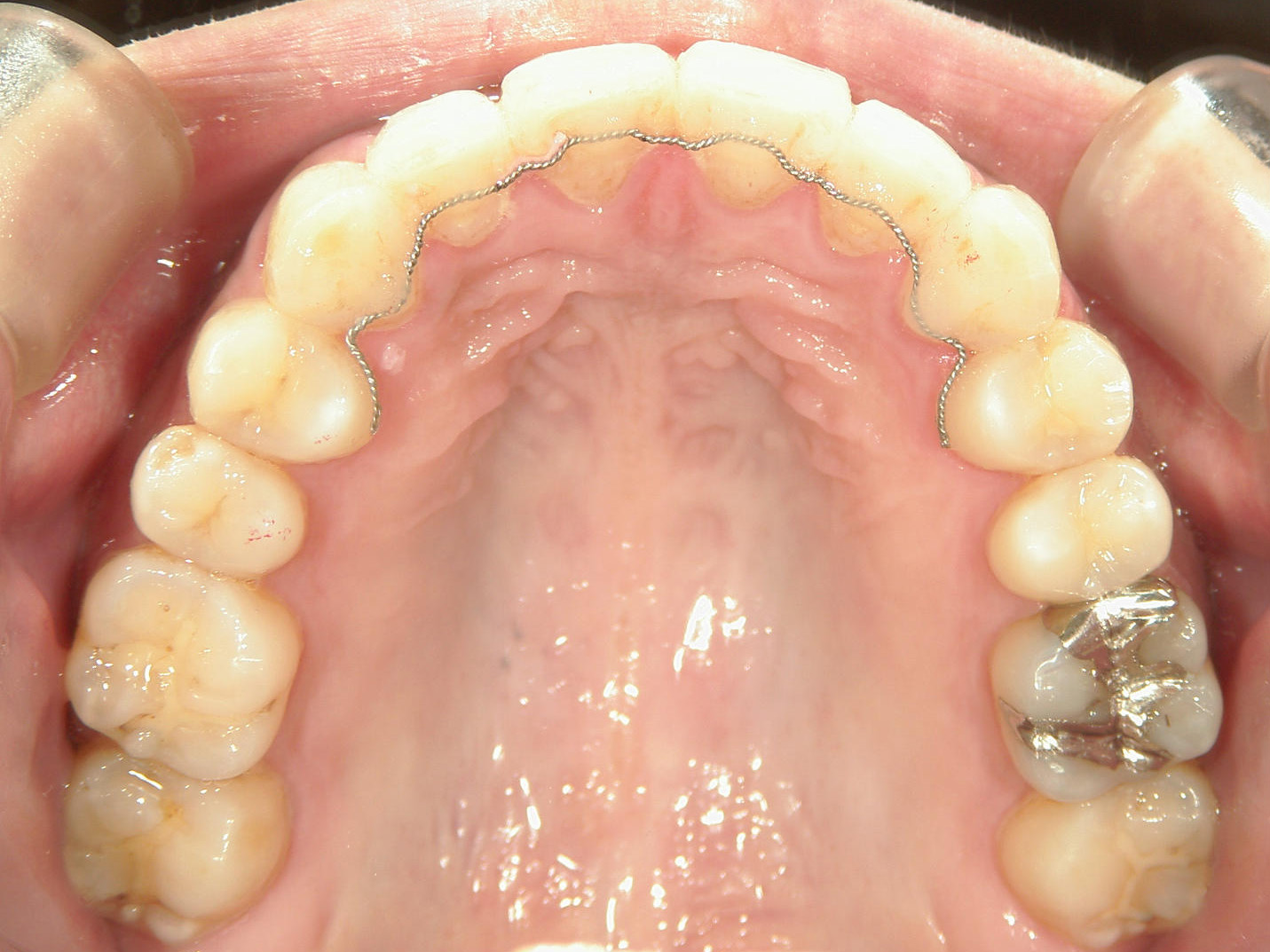 プチワイヤー矯正　症例（61）