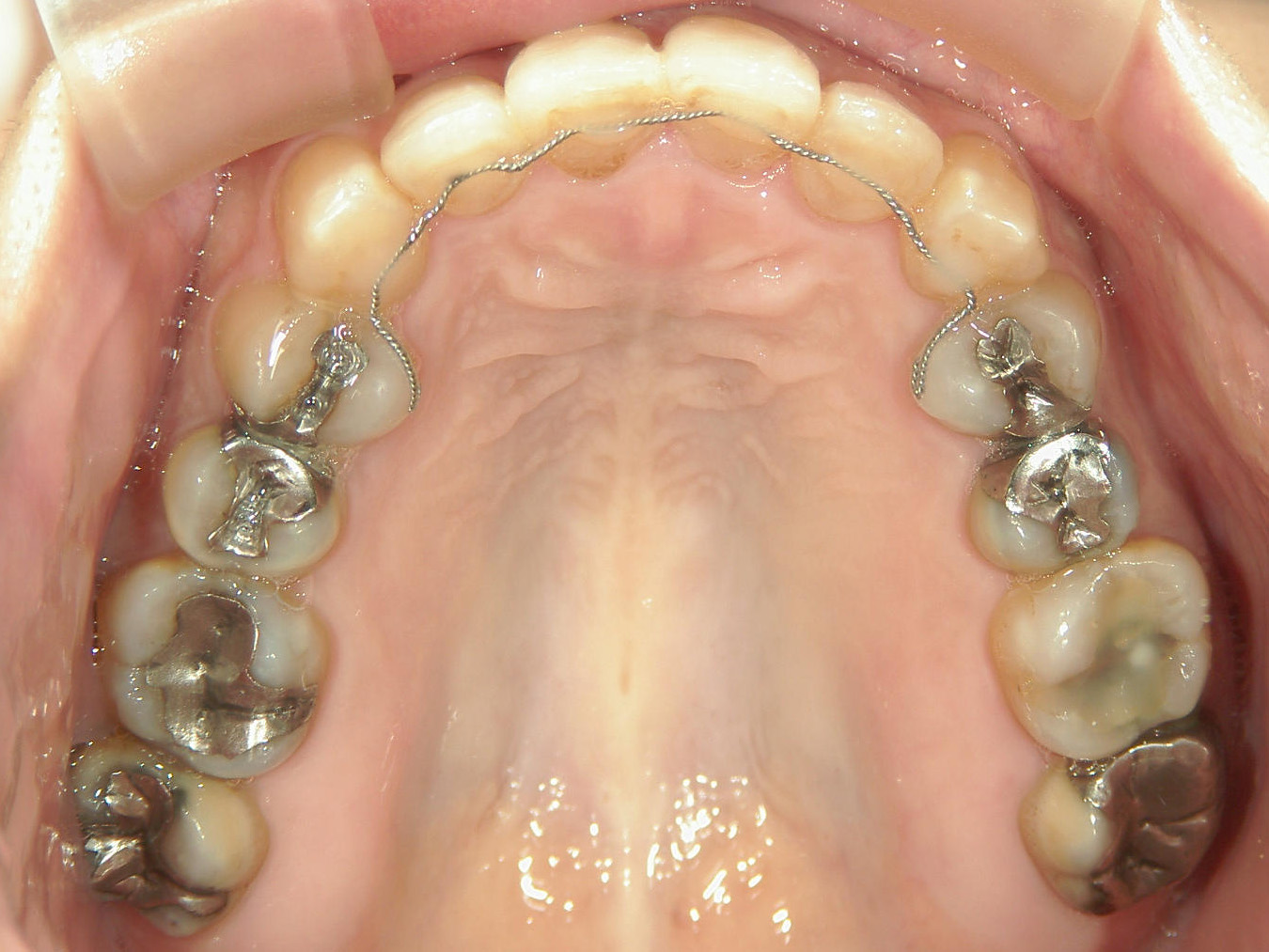 プチワイヤー矯正　症例（59）