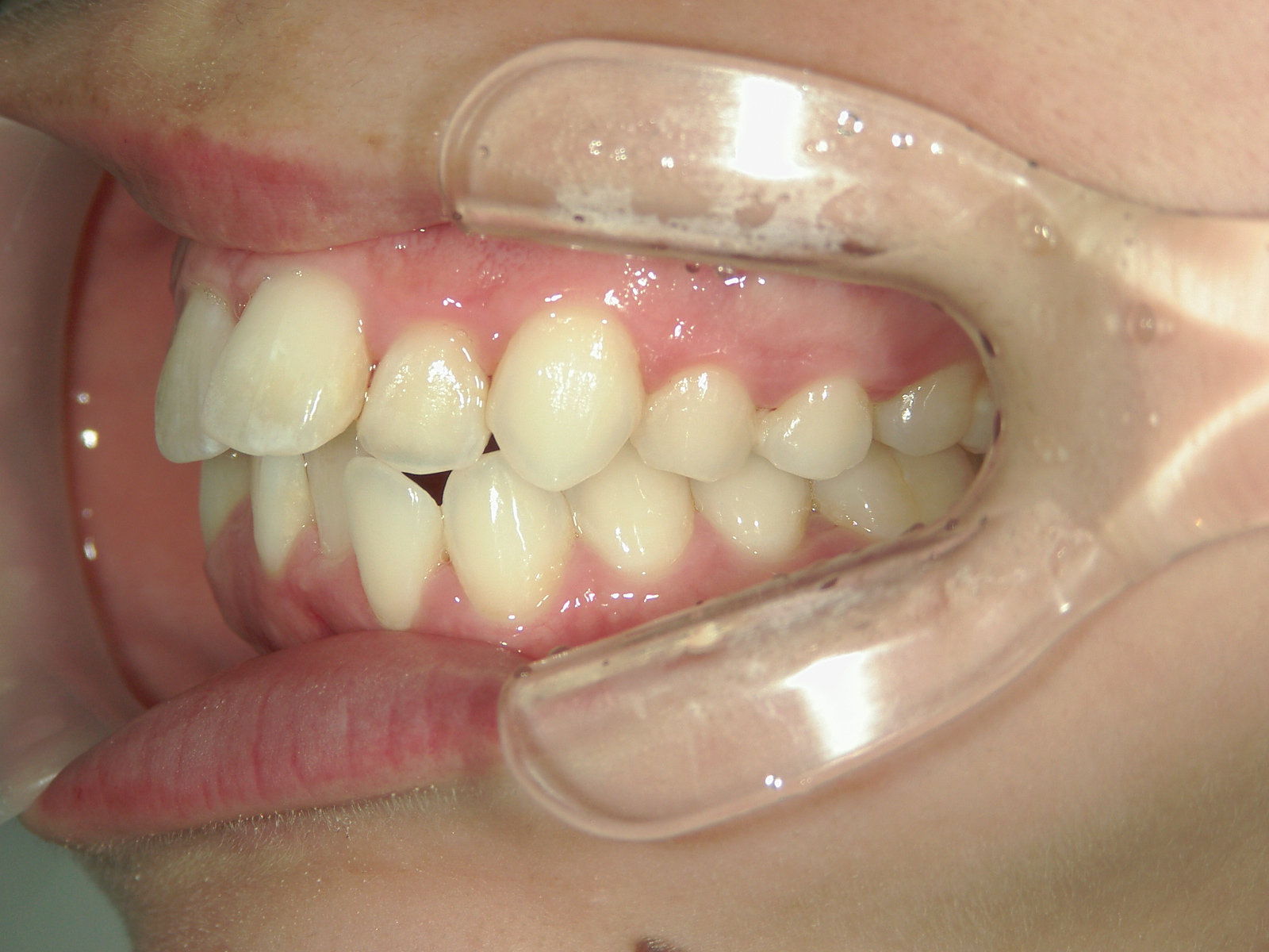 プチワイヤー矯正　症例（60）