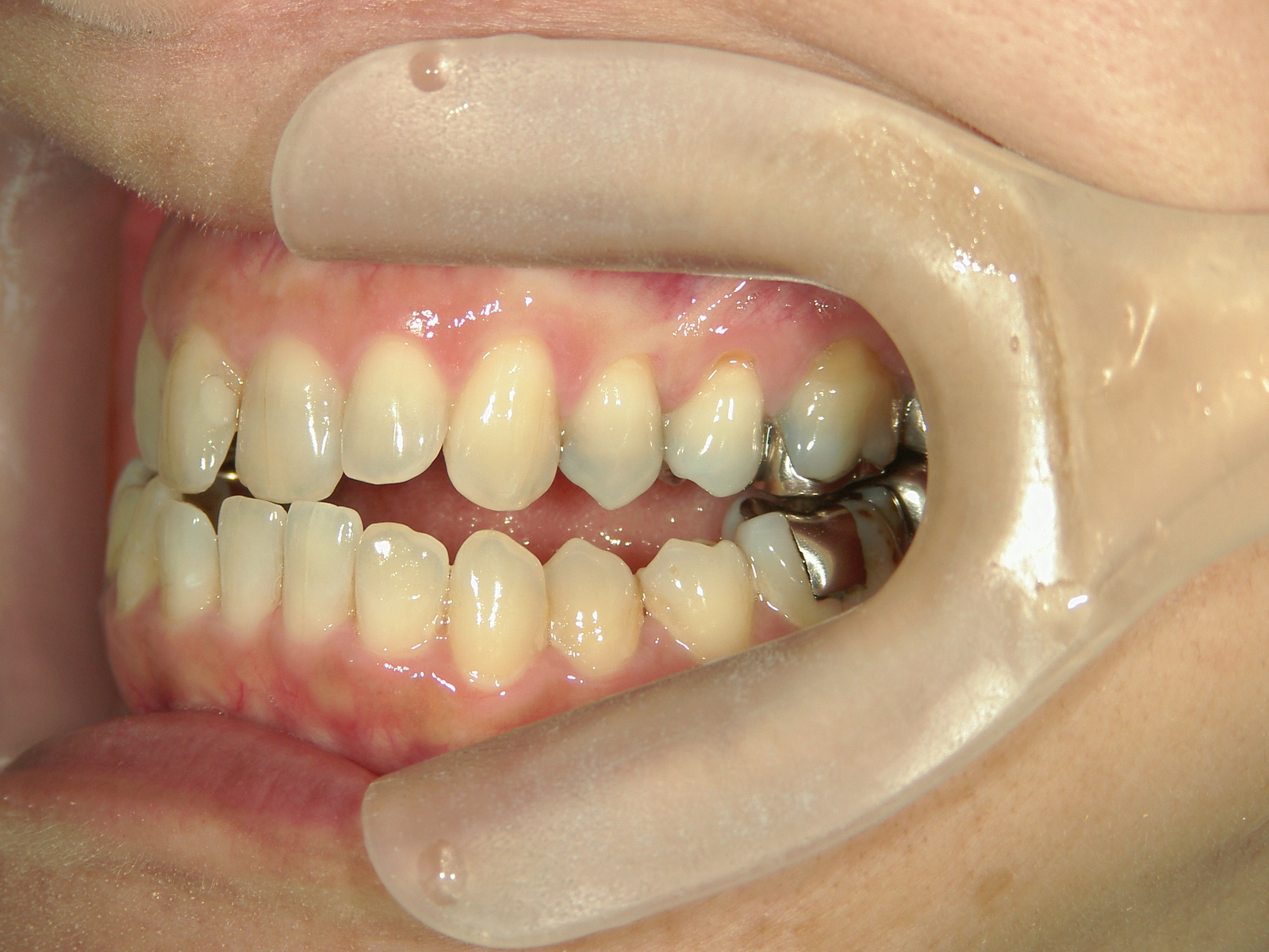 インビザライン矯正　症例（30）