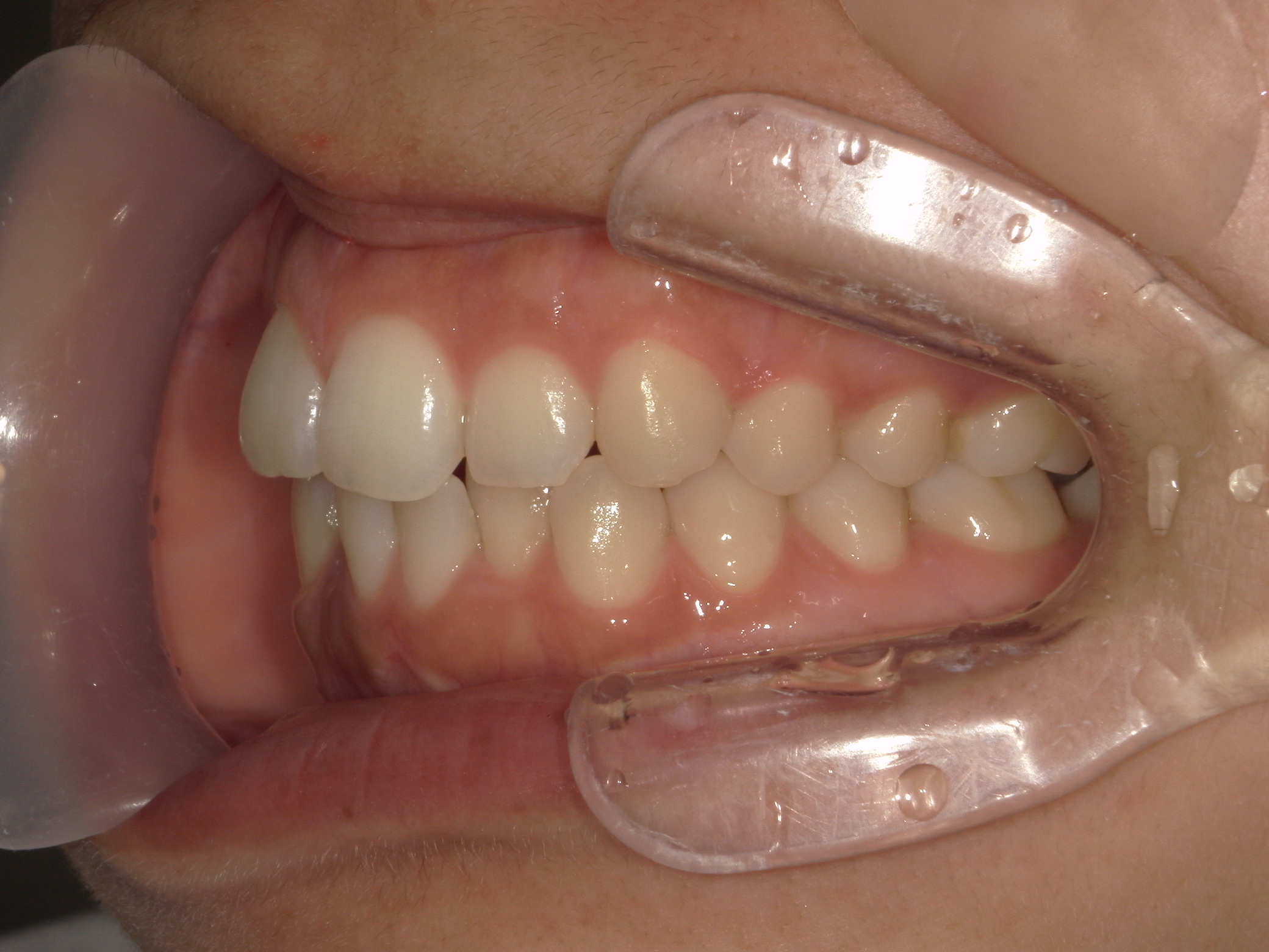 インビザライン(ライト)矯正　症例（31）