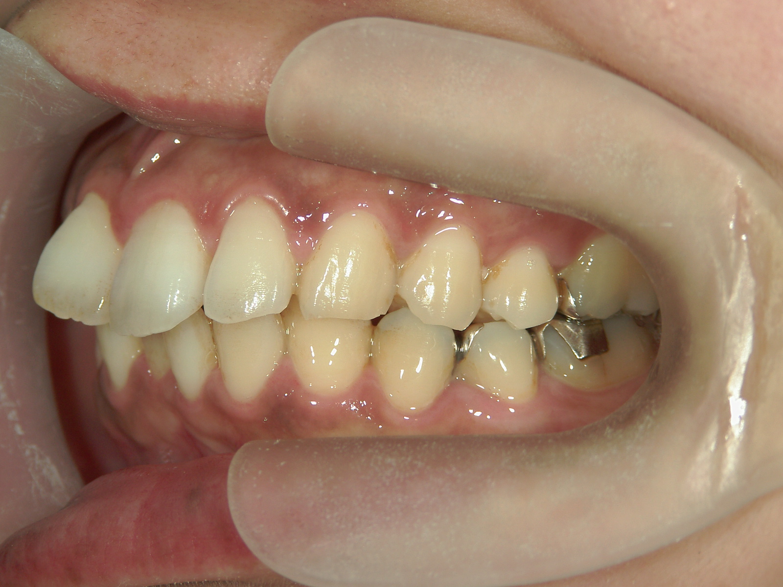 プチワイヤー矯正　症例（61）