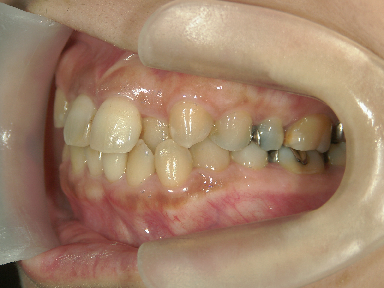 プチワイヤー矯正　症例（59）