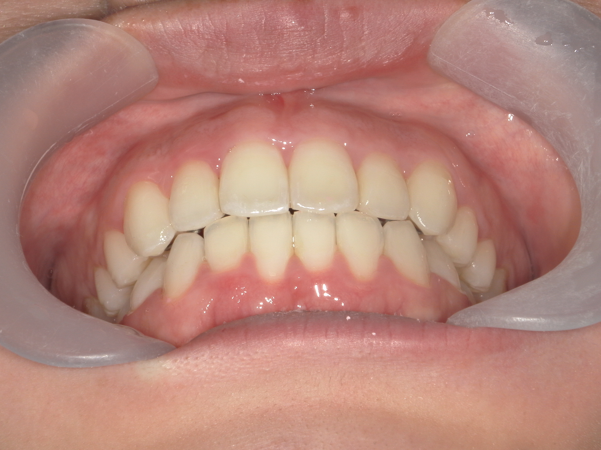 プチワイヤー矯正　症例（60）