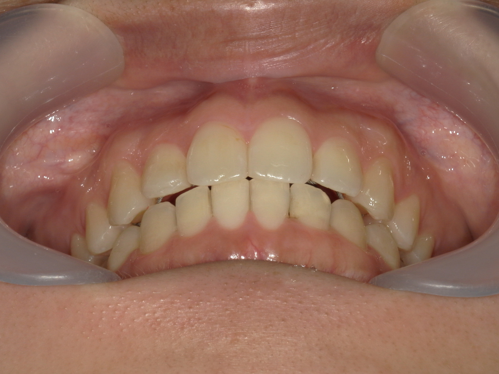 インビザライン(ライト)矯正　症例（31）