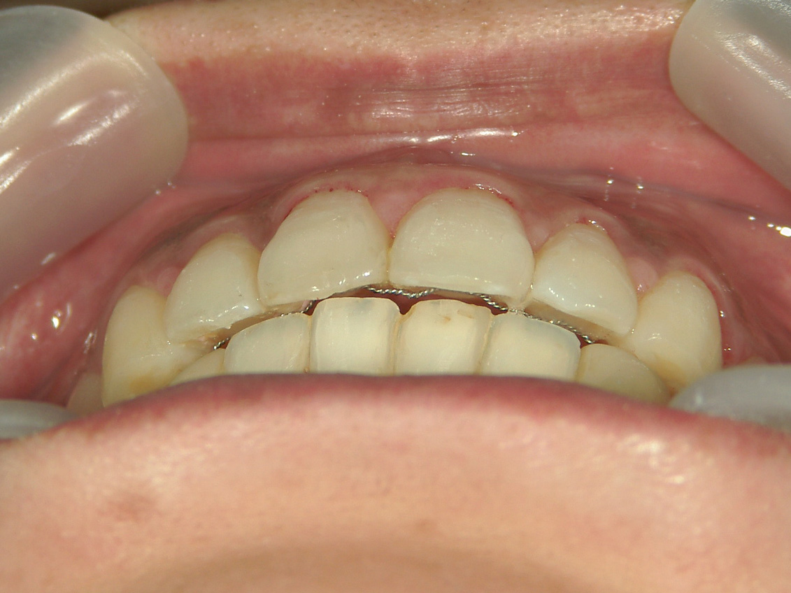 プチワイヤー矯正　症例（61）