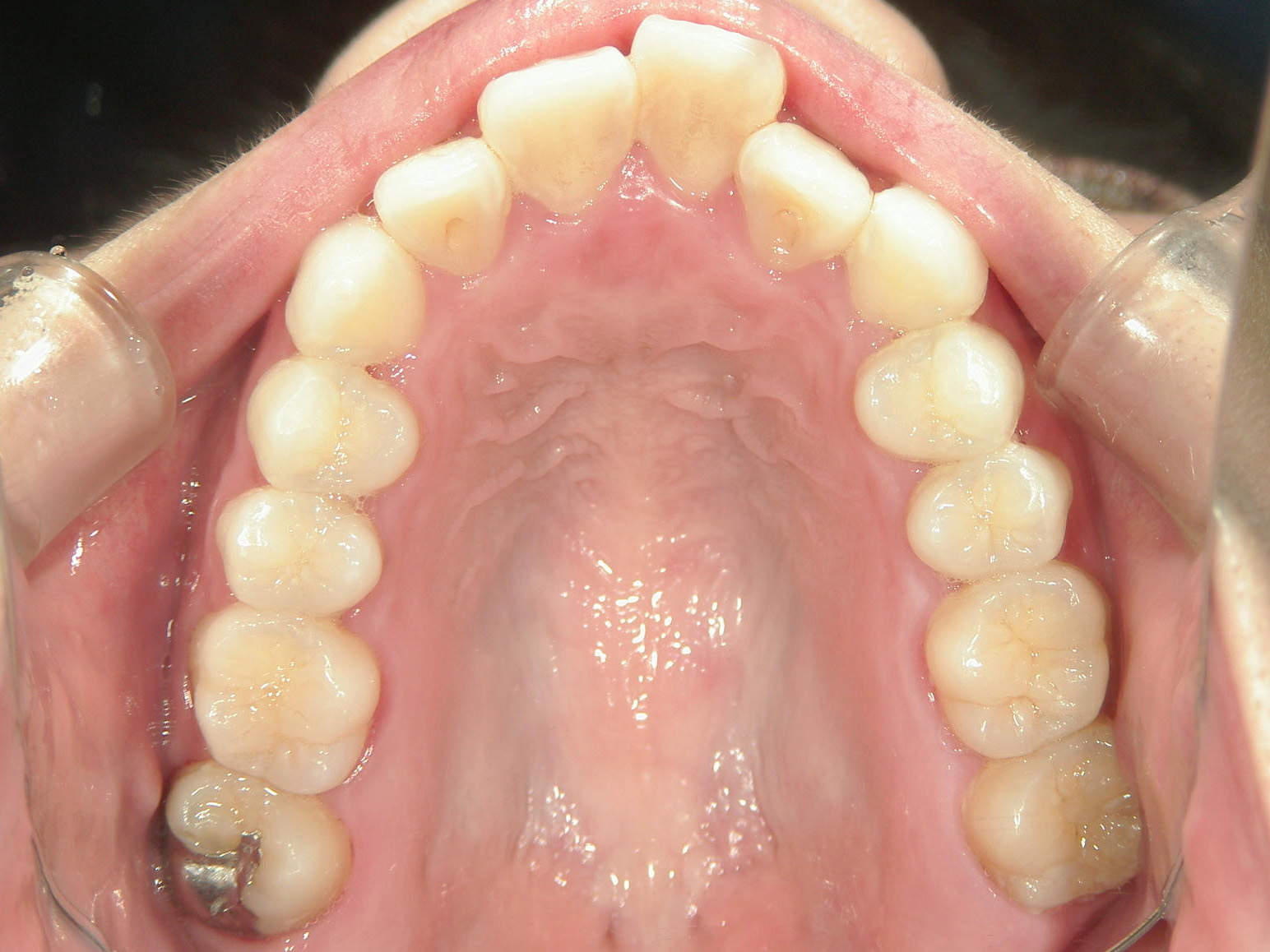 プチワイヤー矯正　症例（60）