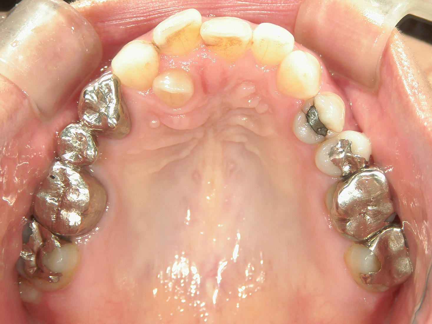 インビザライン矯正　症例（30）