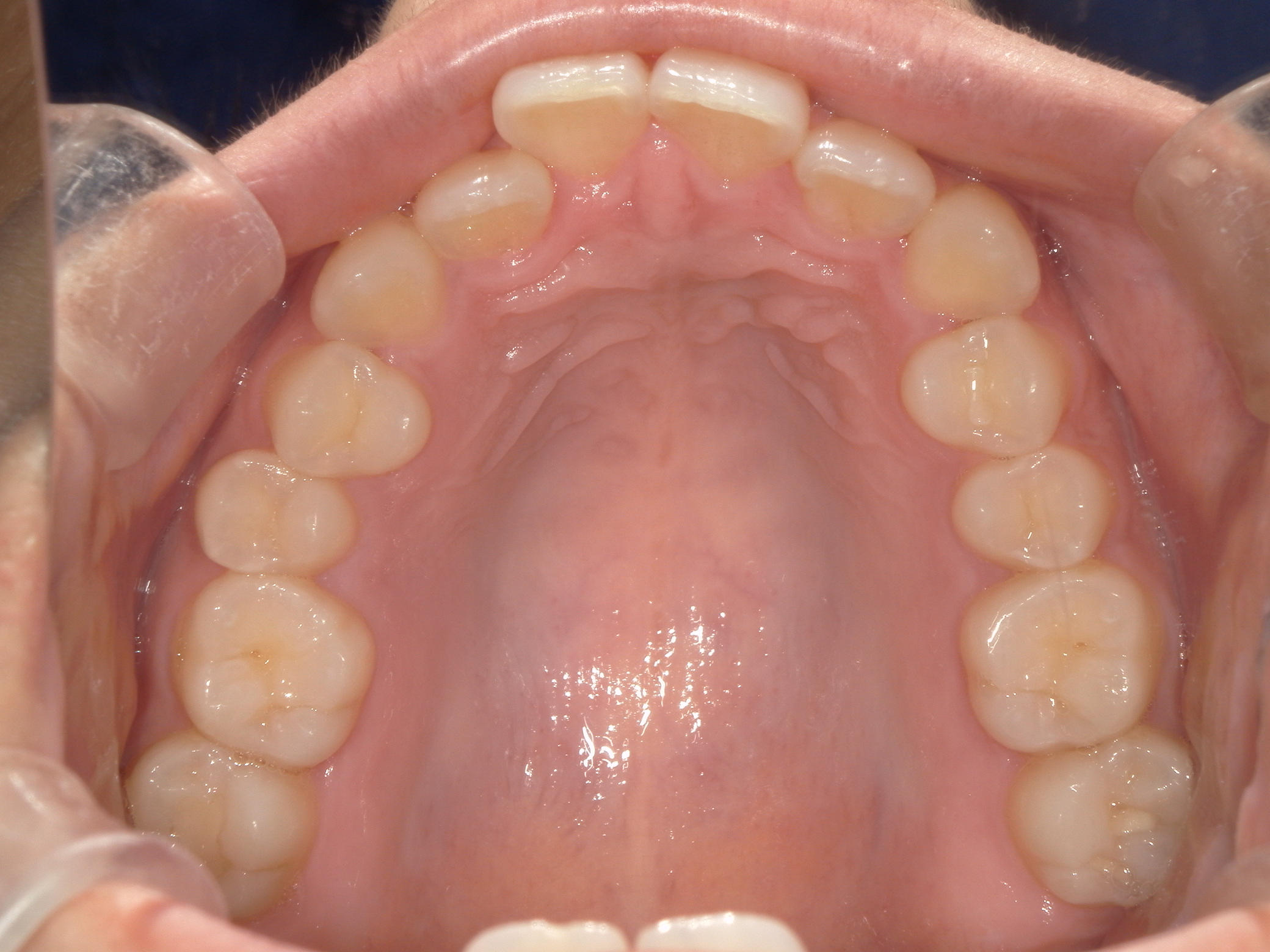 インビザライン(ライト)矯正　症例（31）