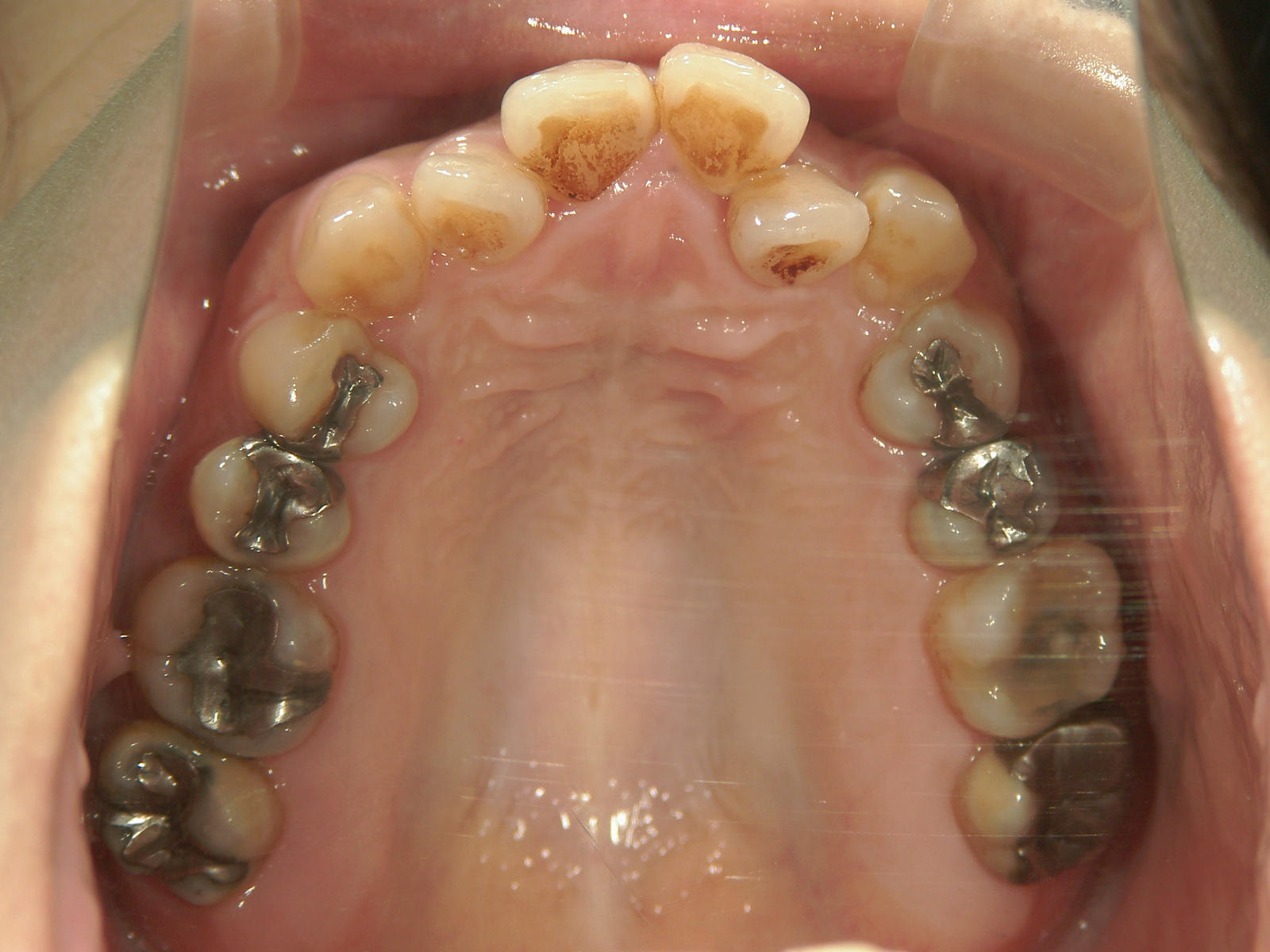 プチワイヤー矯正　症例（59）