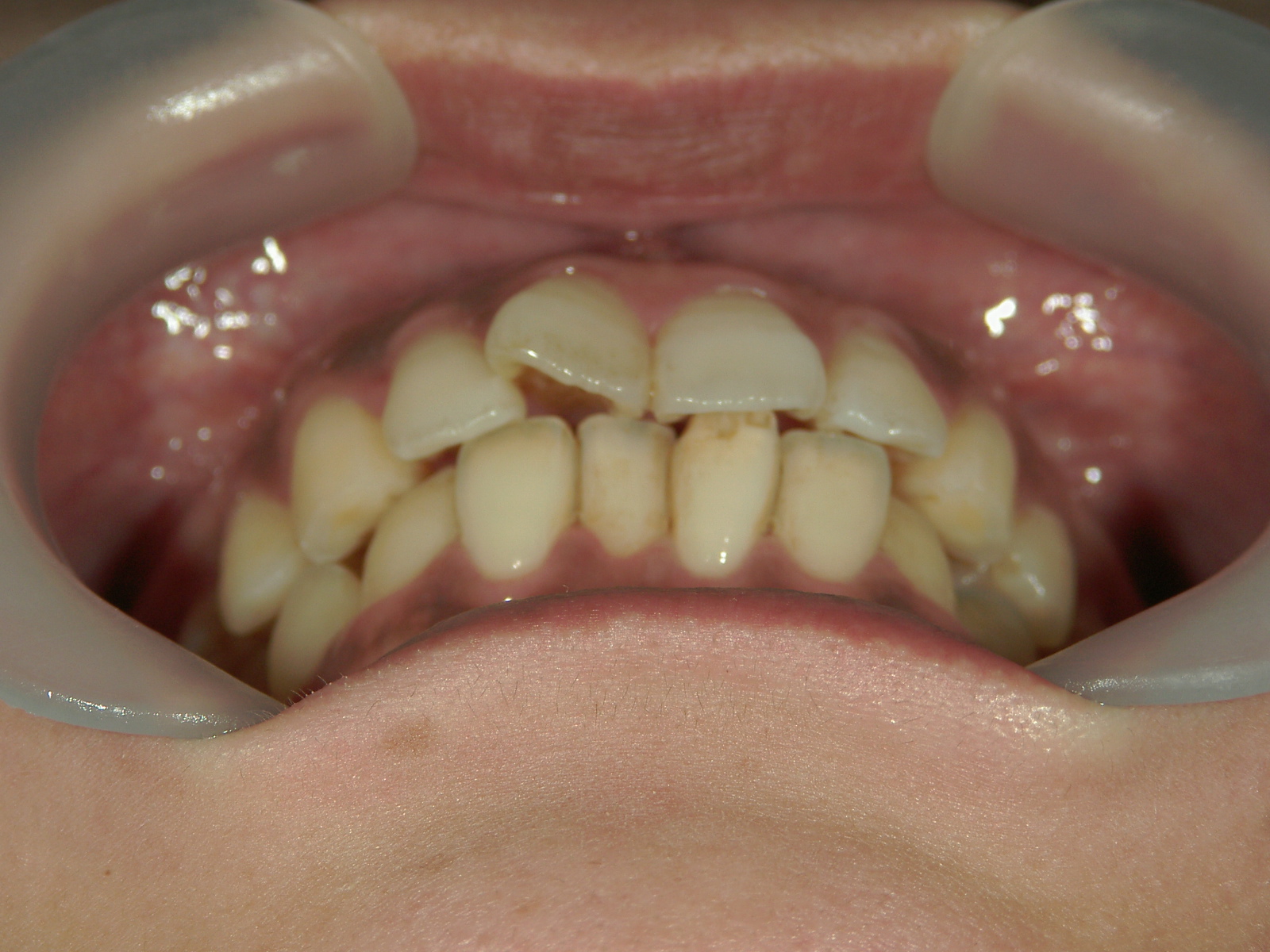 プチワイヤー矯正　症例（61）