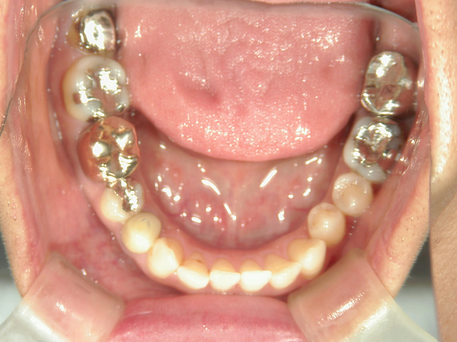 インビザライン矯正　症例（30）