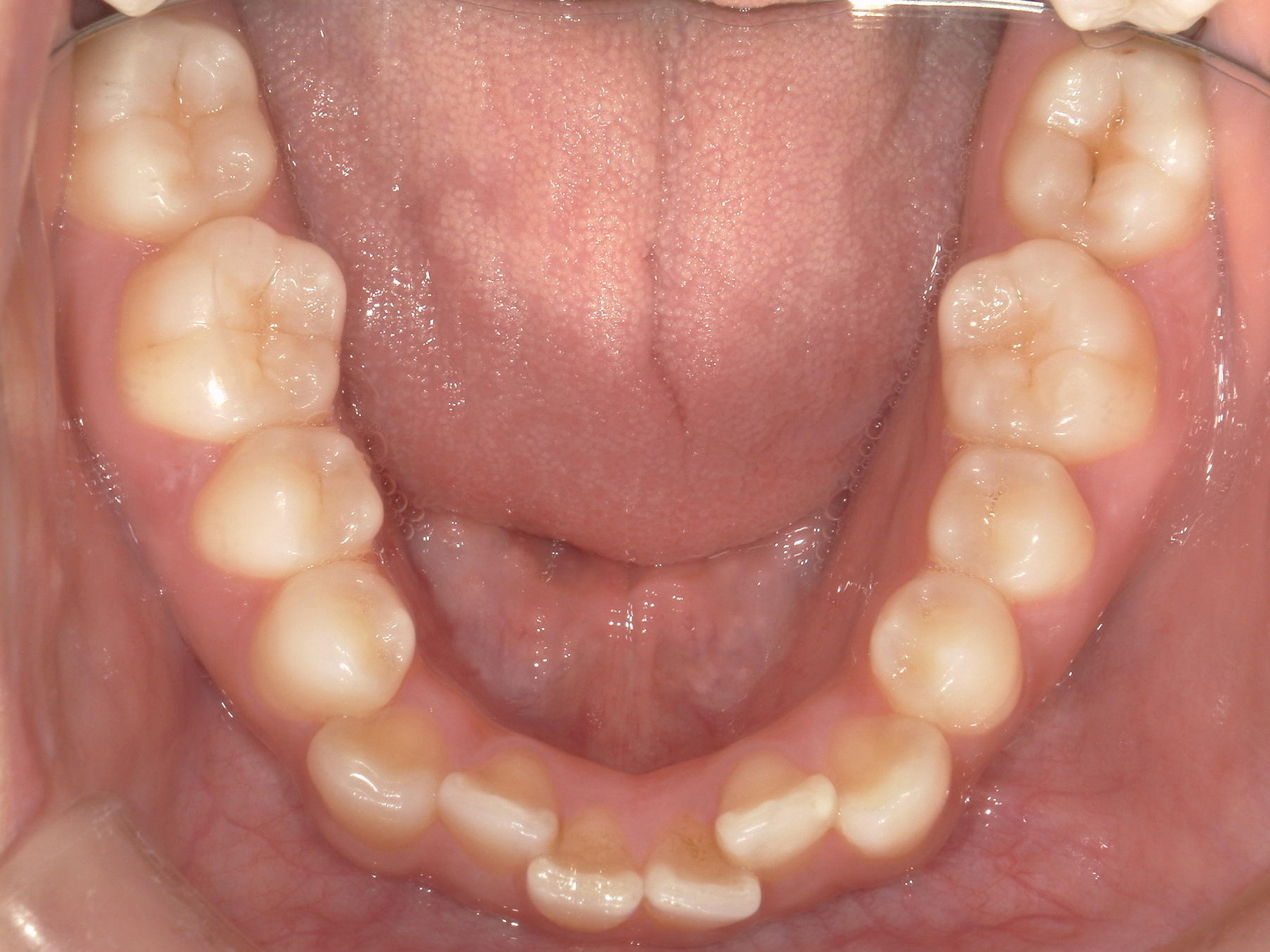 インビザライン(ライト)矯正　症例（31）