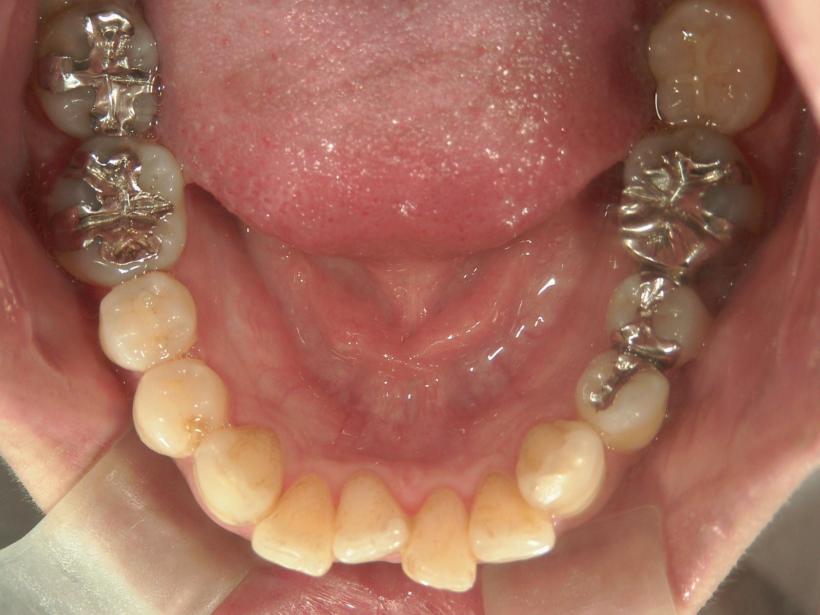 プチワイヤー矯正　症例（61）