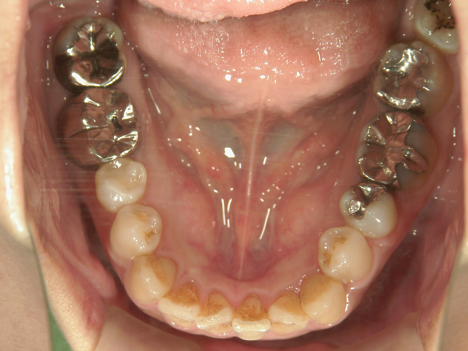 プチワイヤー矯正　症例（59）
