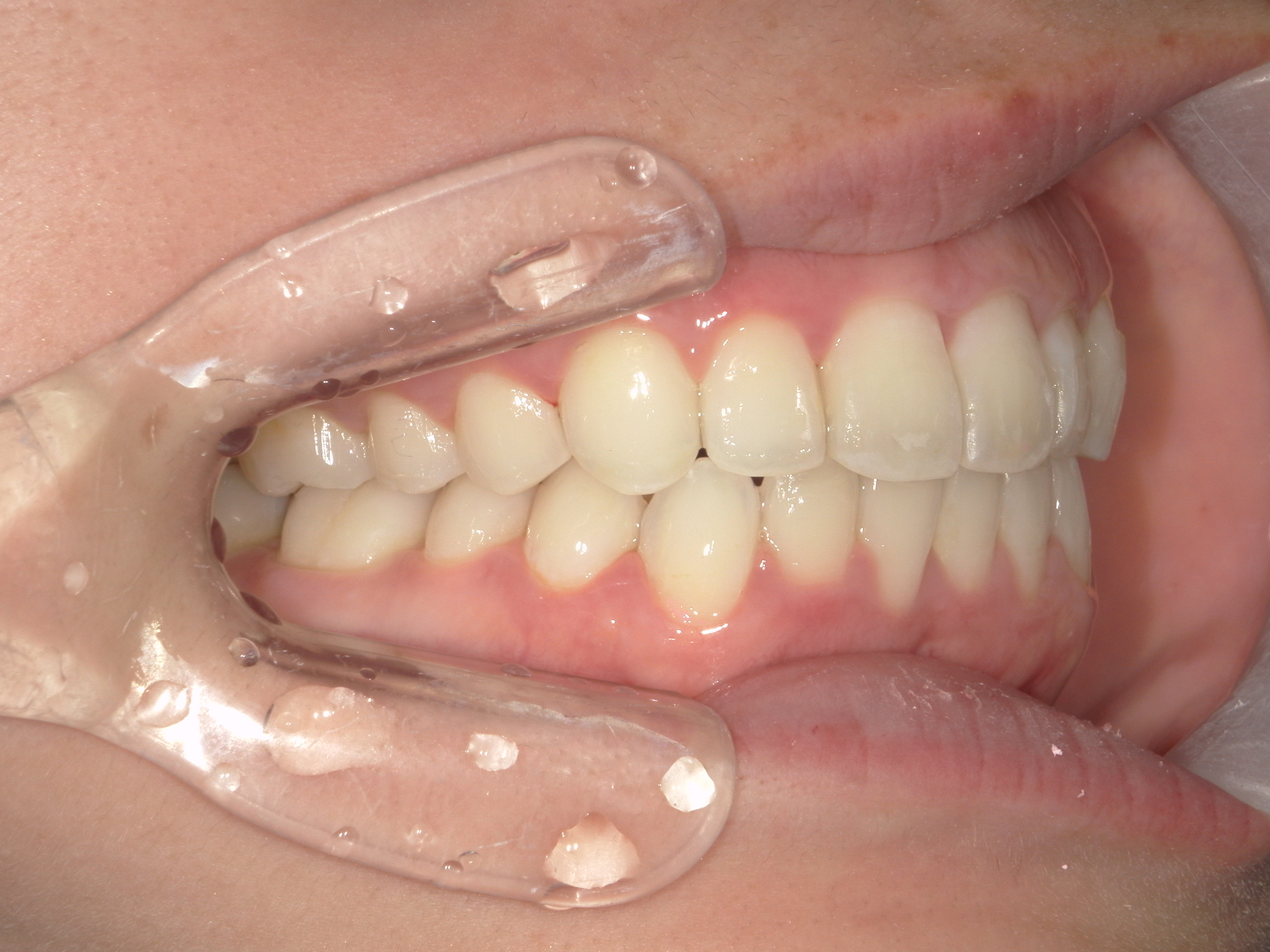 プチワイヤー矯正　症例（60）