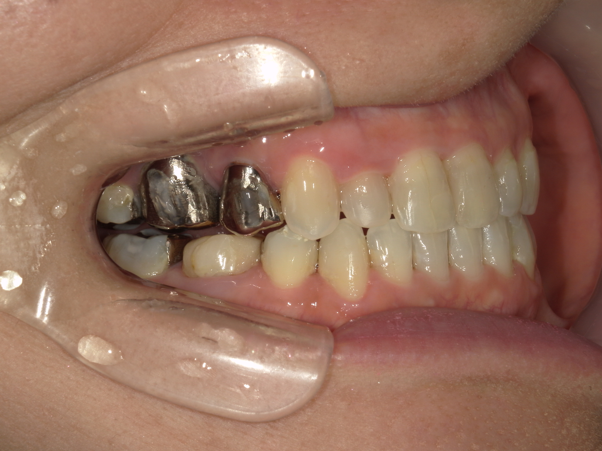 インビザライン矯正　症例（30）