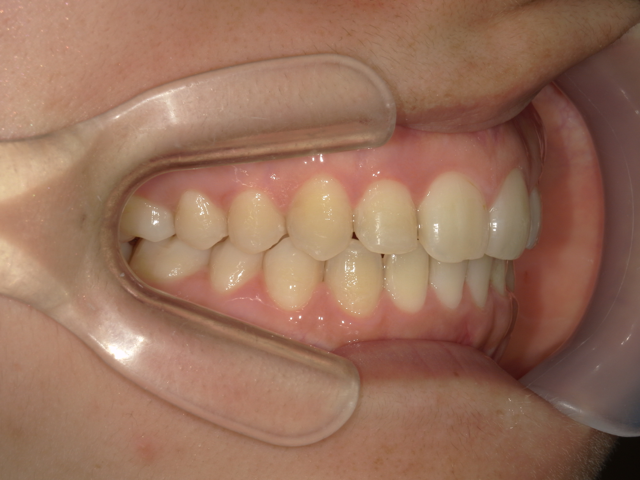 インビザライン(ライト)矯正　症例（31）