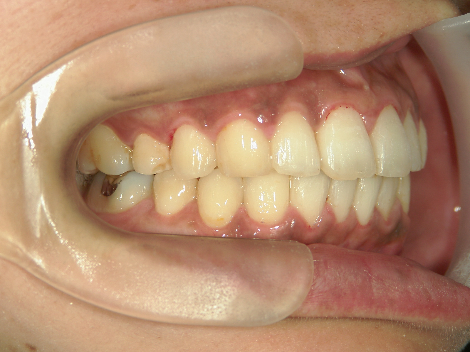 プチワイヤー矯正　症例（61）