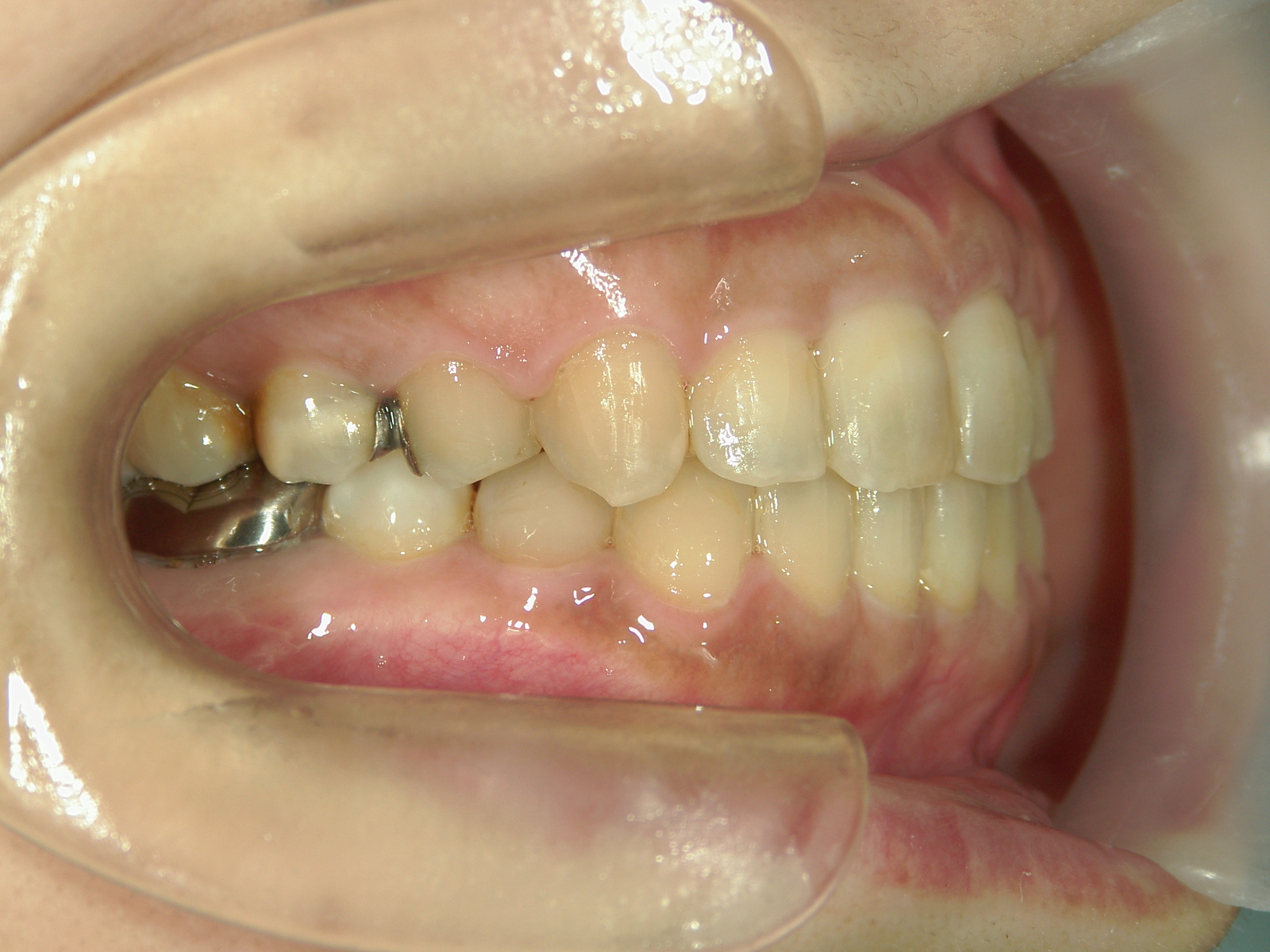 プチワイヤー矯正　症例（59）