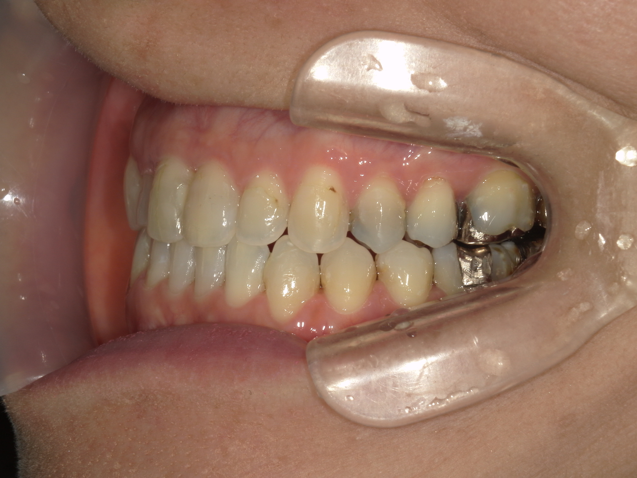 インビザライン矯正　症例（30）