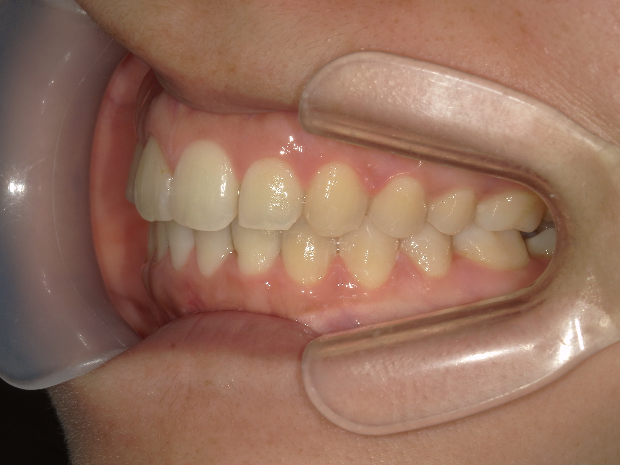 インビザライン(ライト)矯正　症例（31）