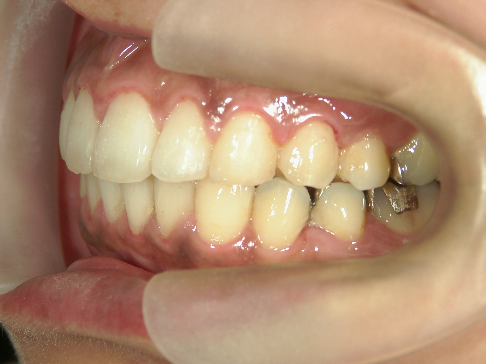 プチワイヤー矯正　症例（61）