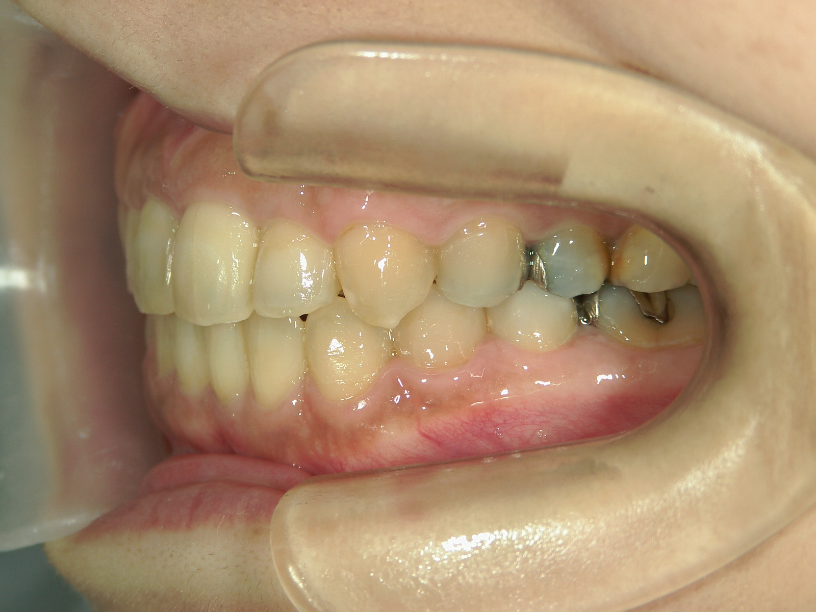 プチワイヤー矯正　症例（59）