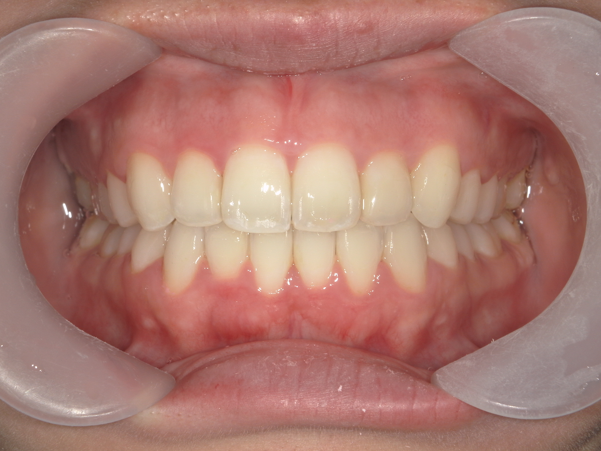 プチワイヤー矯正　症例（60）