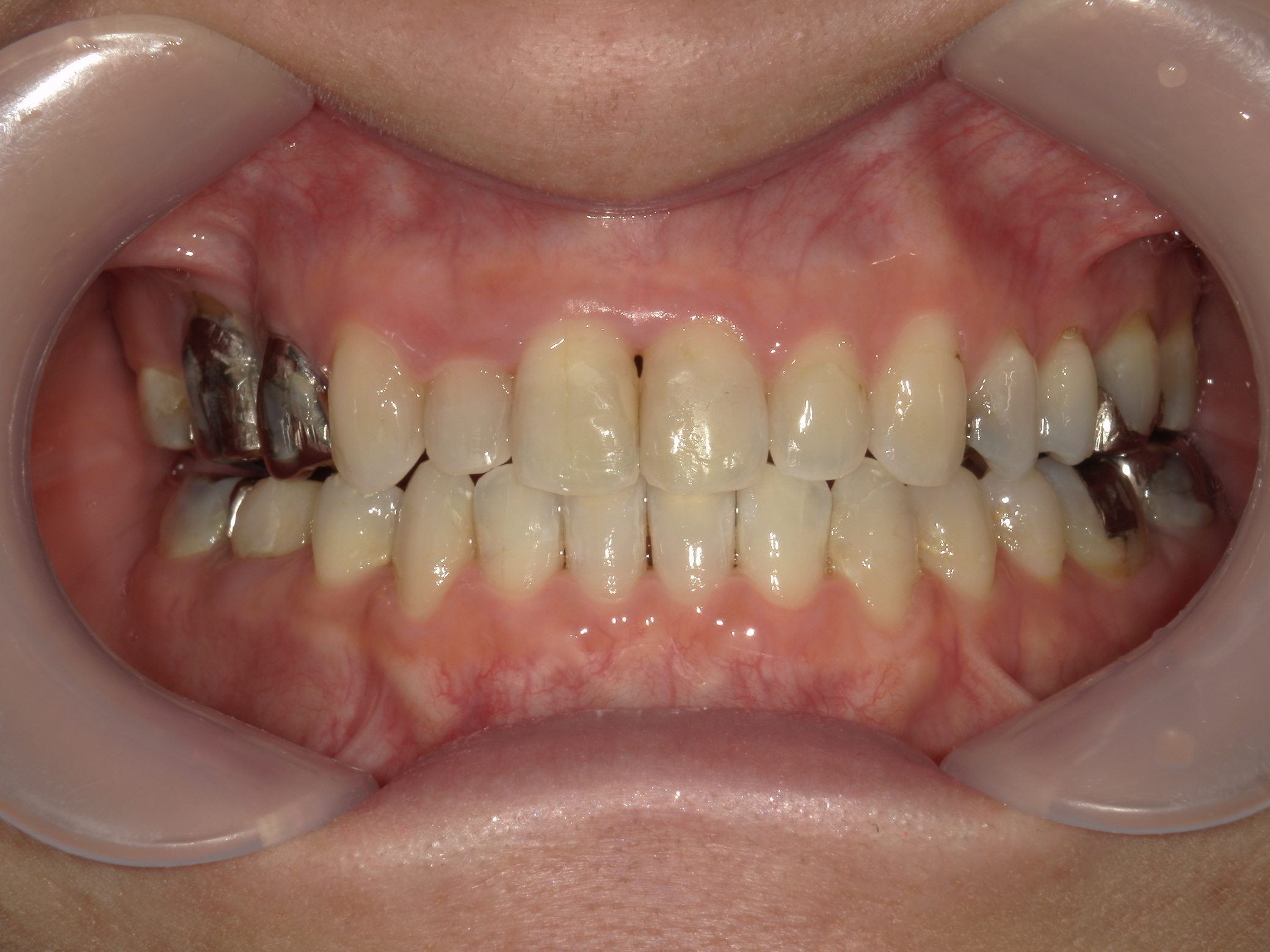 インビザライン矯正　症例（30）