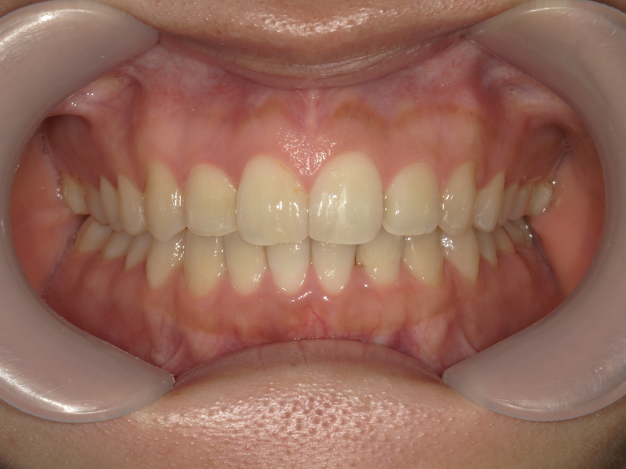 インビザライン(ライト)矯正　症例（31）