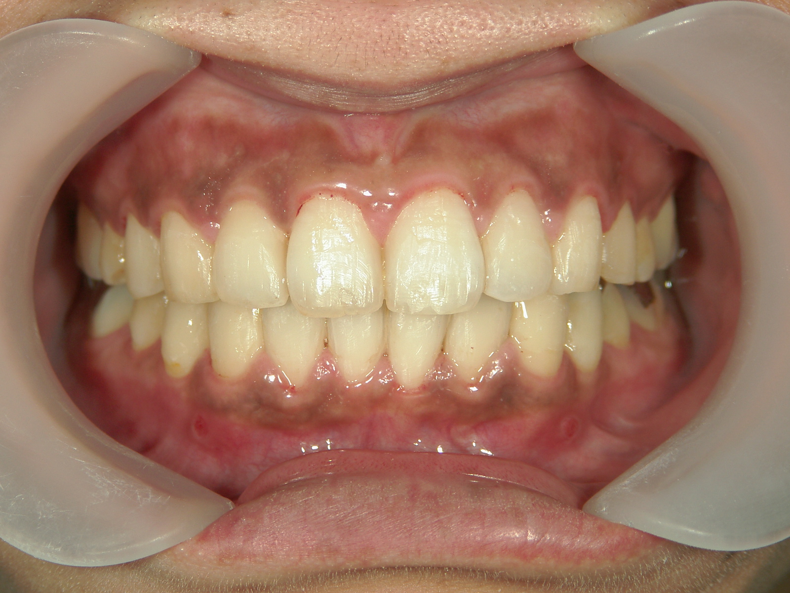 プチワイヤー矯正　症例（61）