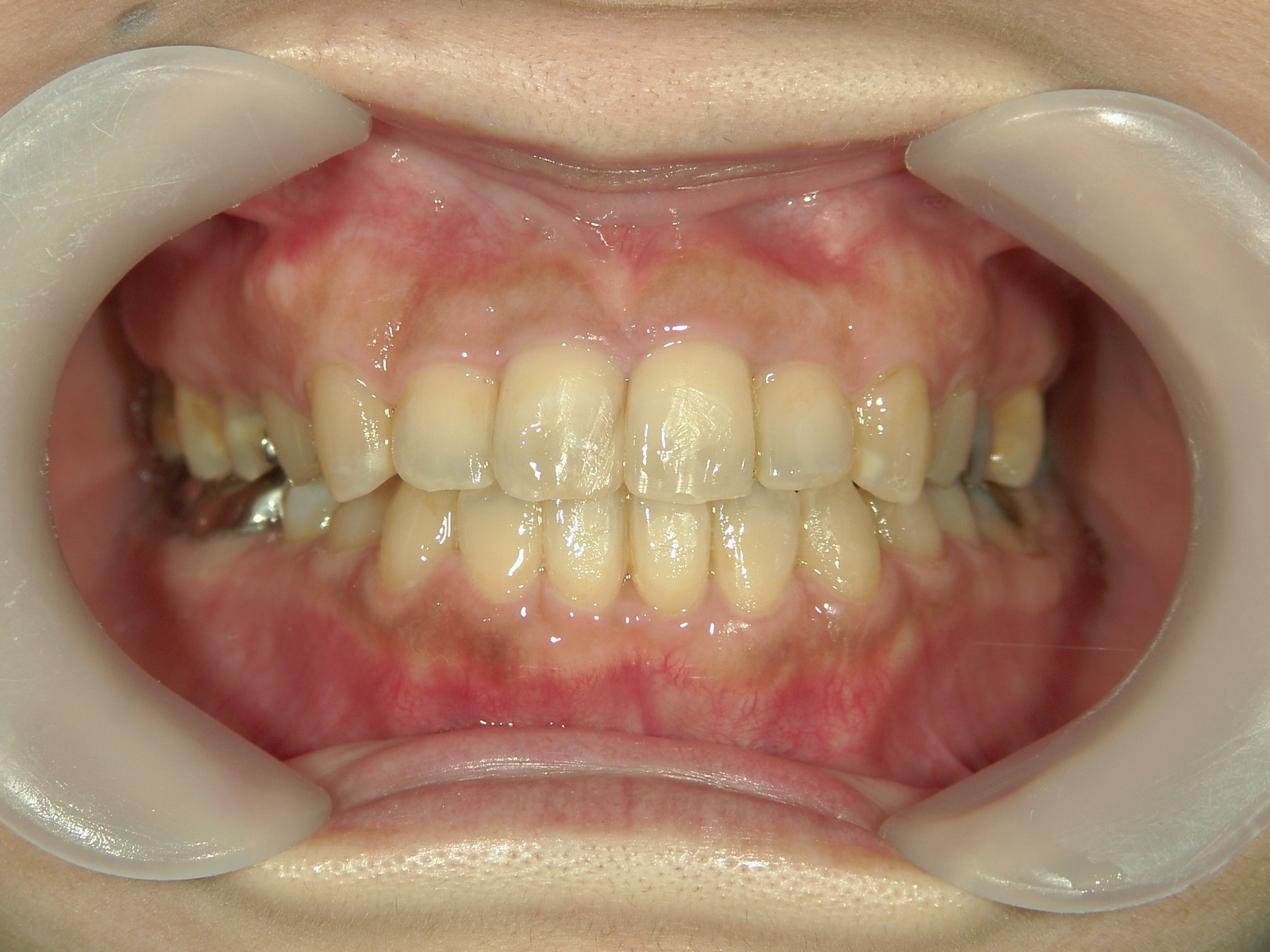 プチワイヤー矯正　症例（59）