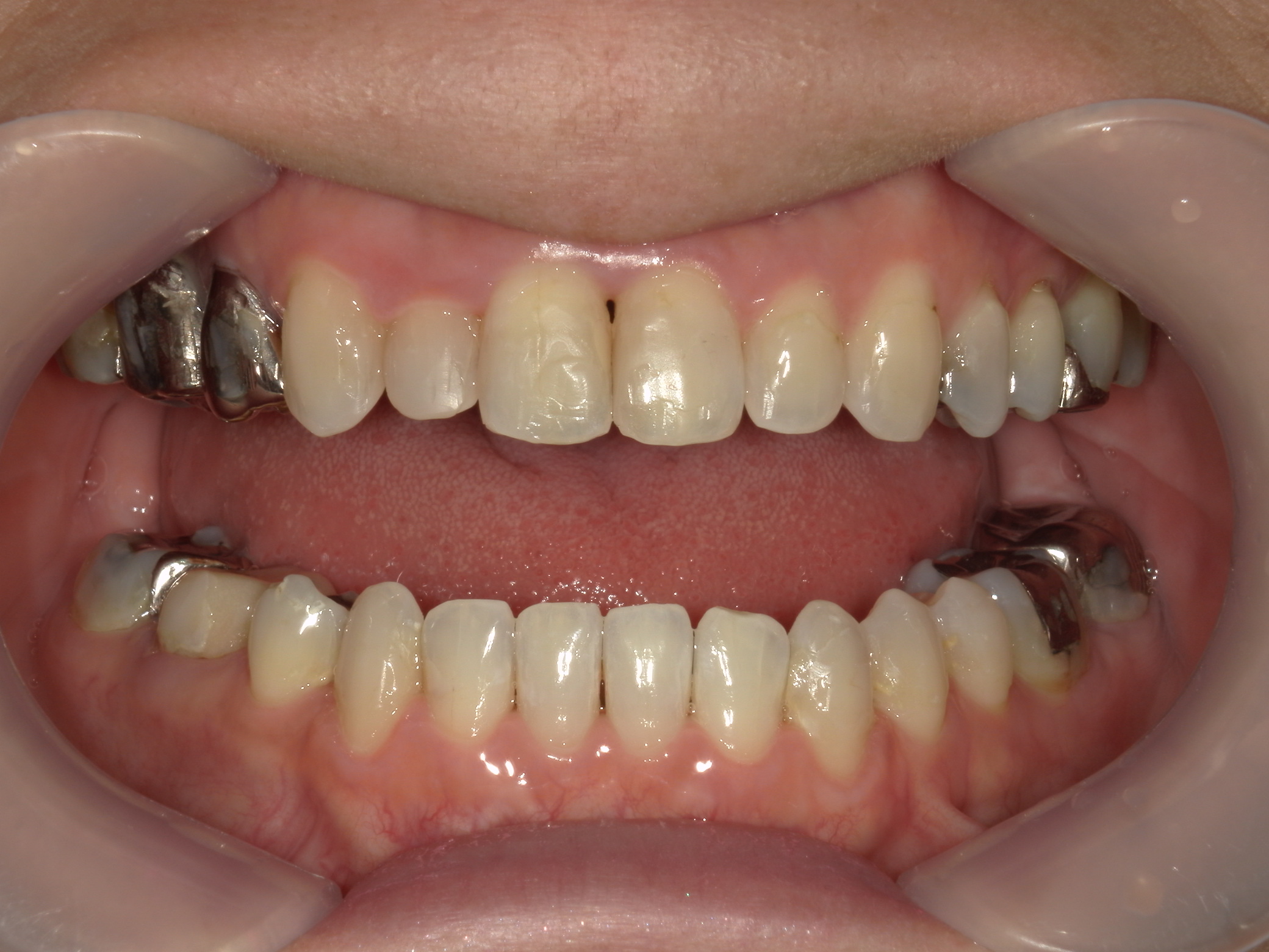 インビザライン矯正　症例（30）