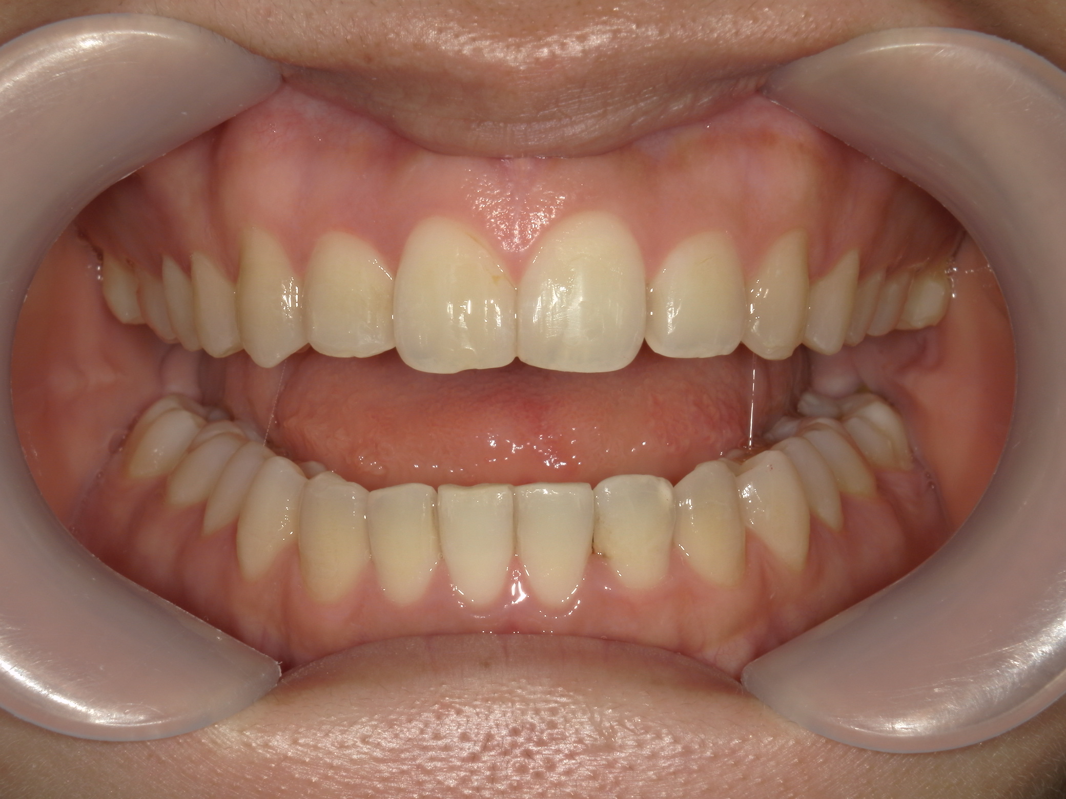 インビザライン(ライト)矯正　症例（31）