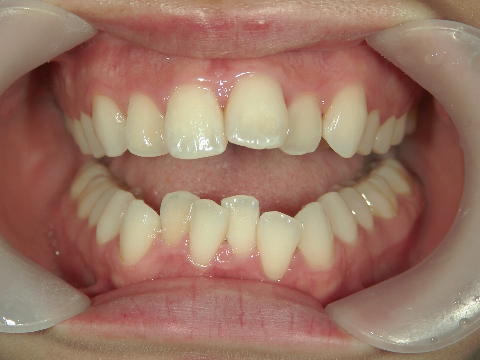 プチワイヤー矯正　症例（60）