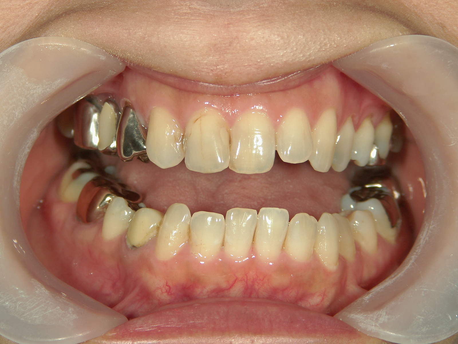 インビザライン矯正　症例（30）