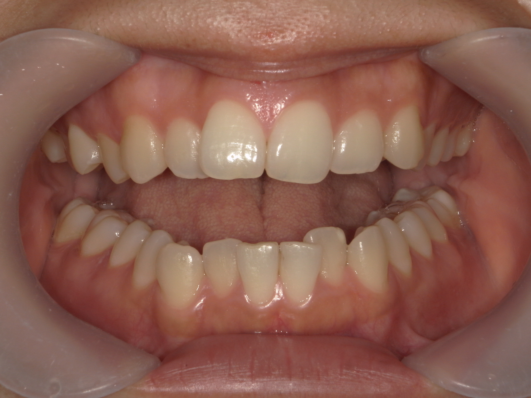 インビザライン(ライト)矯正　症例（31）