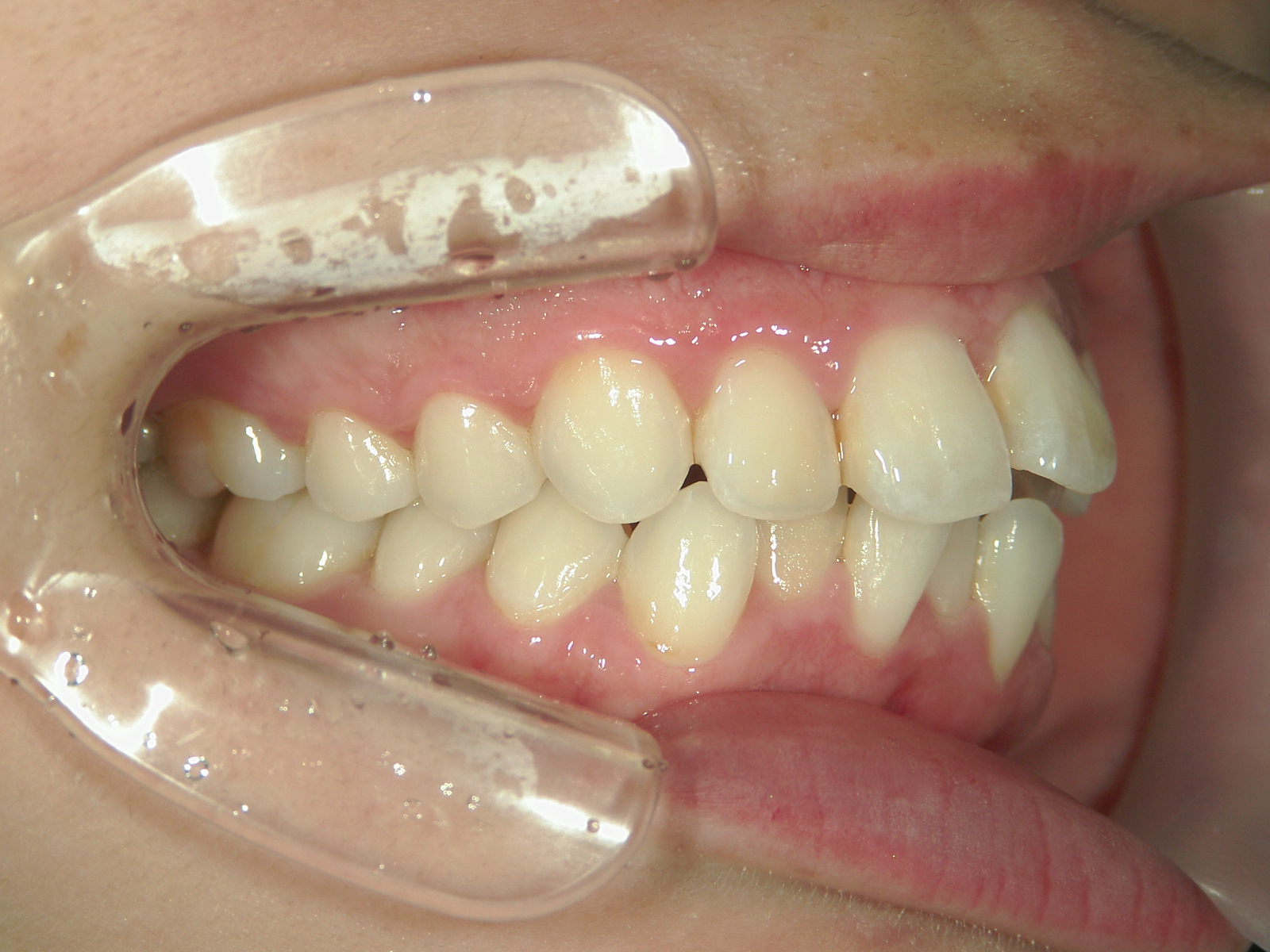 プチワイヤー矯正　症例（60）