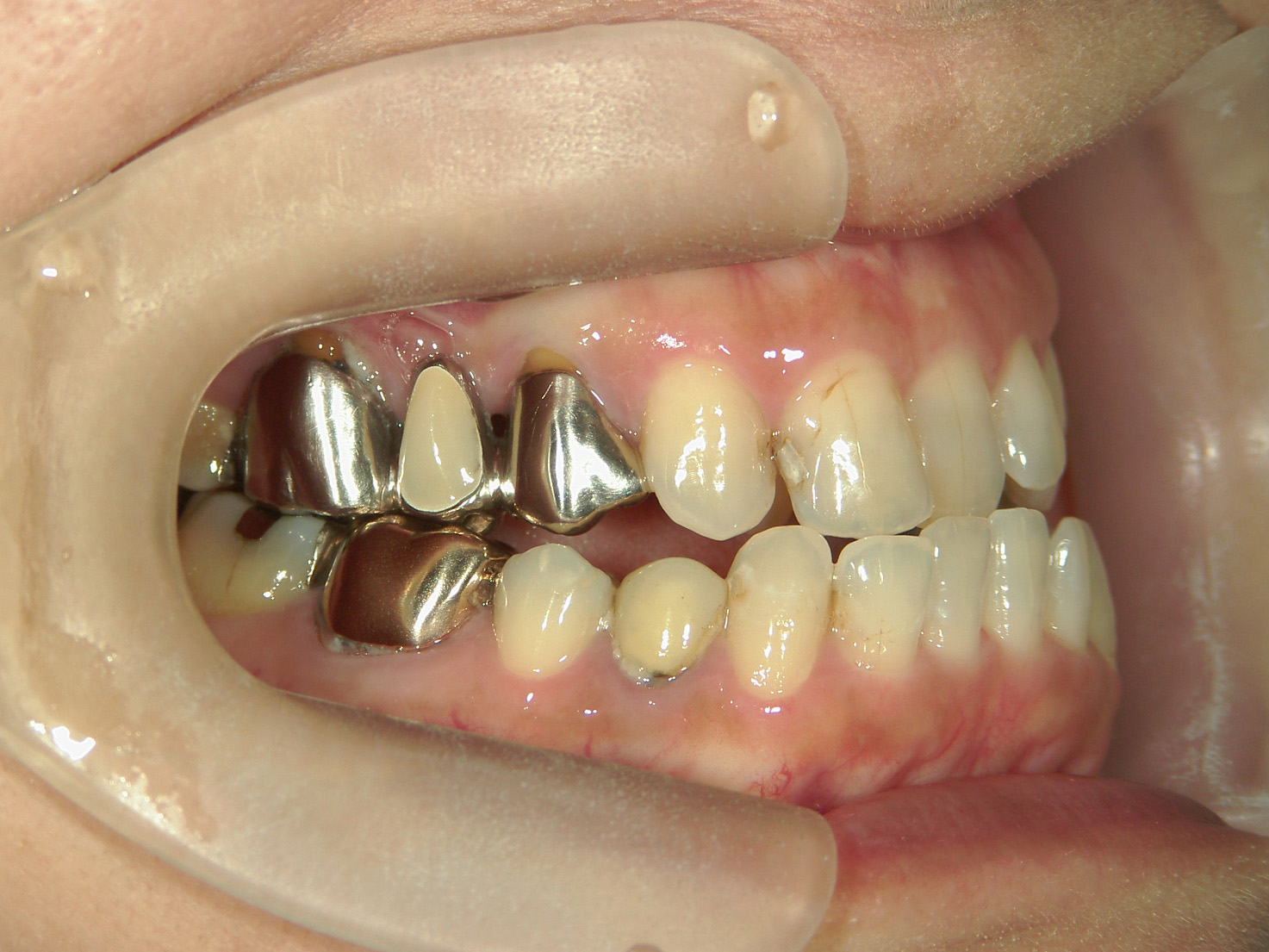 インビザライン矯正　症例（30）