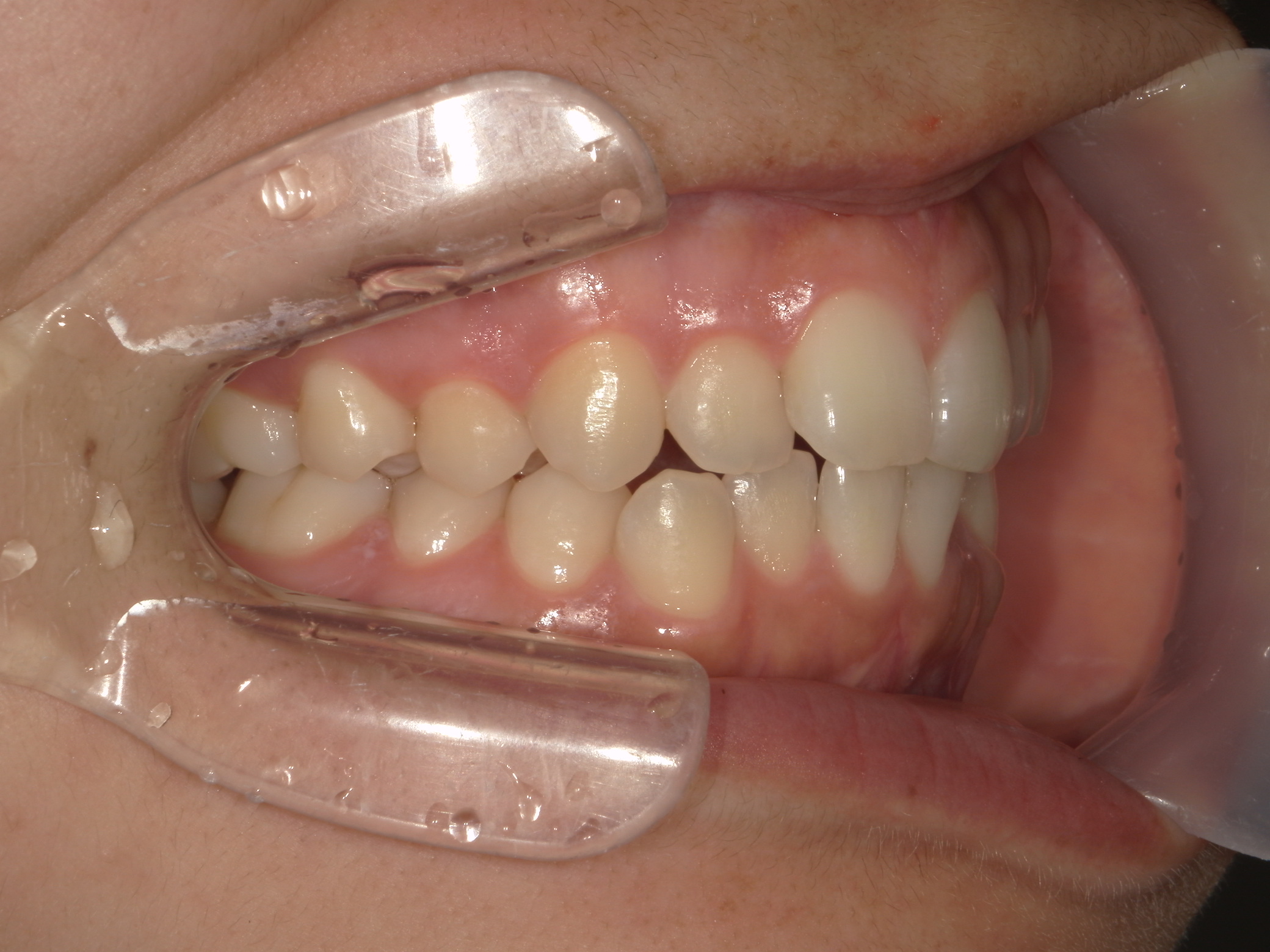 インビザライン(ライト)矯正　症例（31）