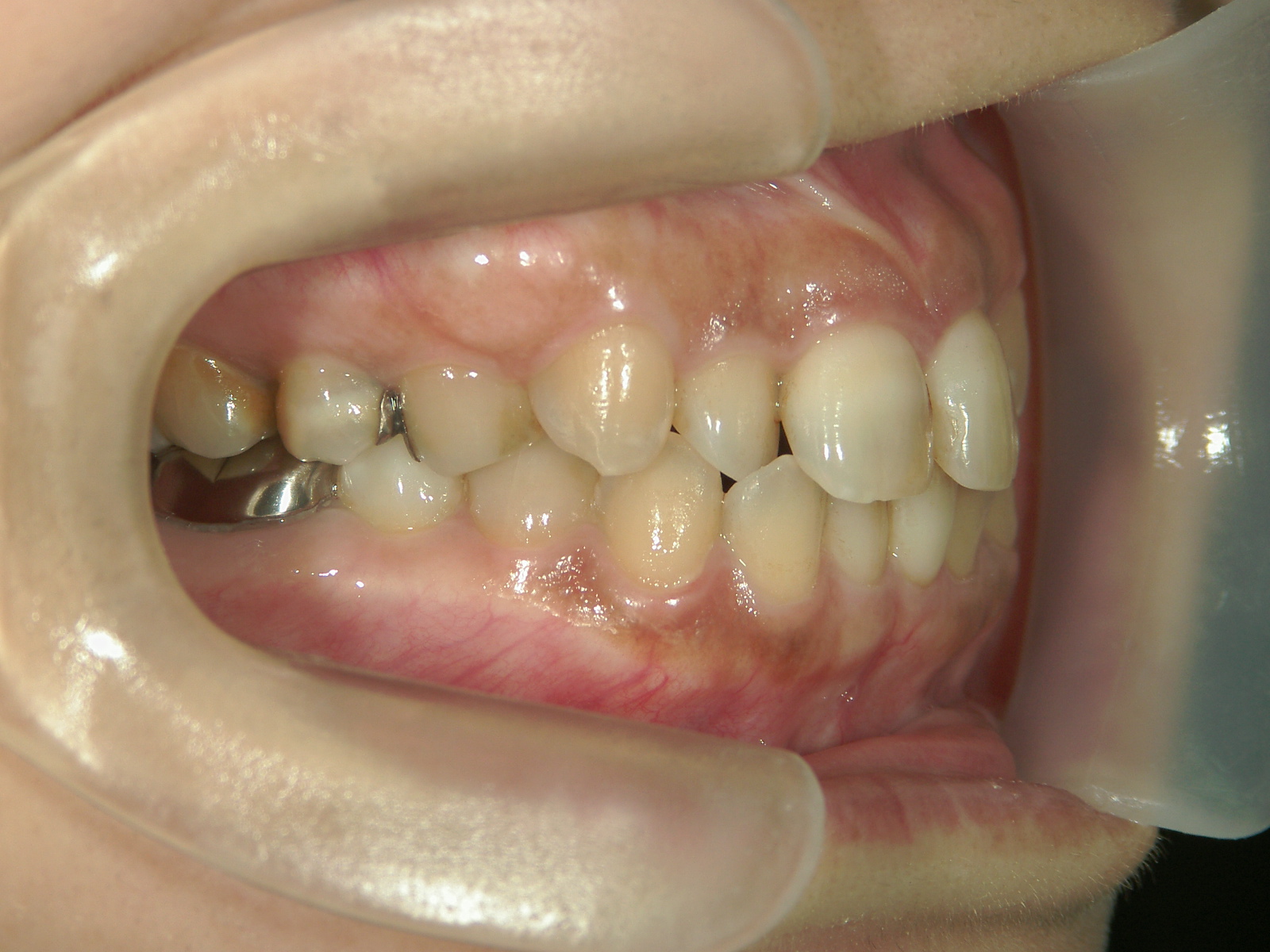 プチワイヤー矯正　症例（59）