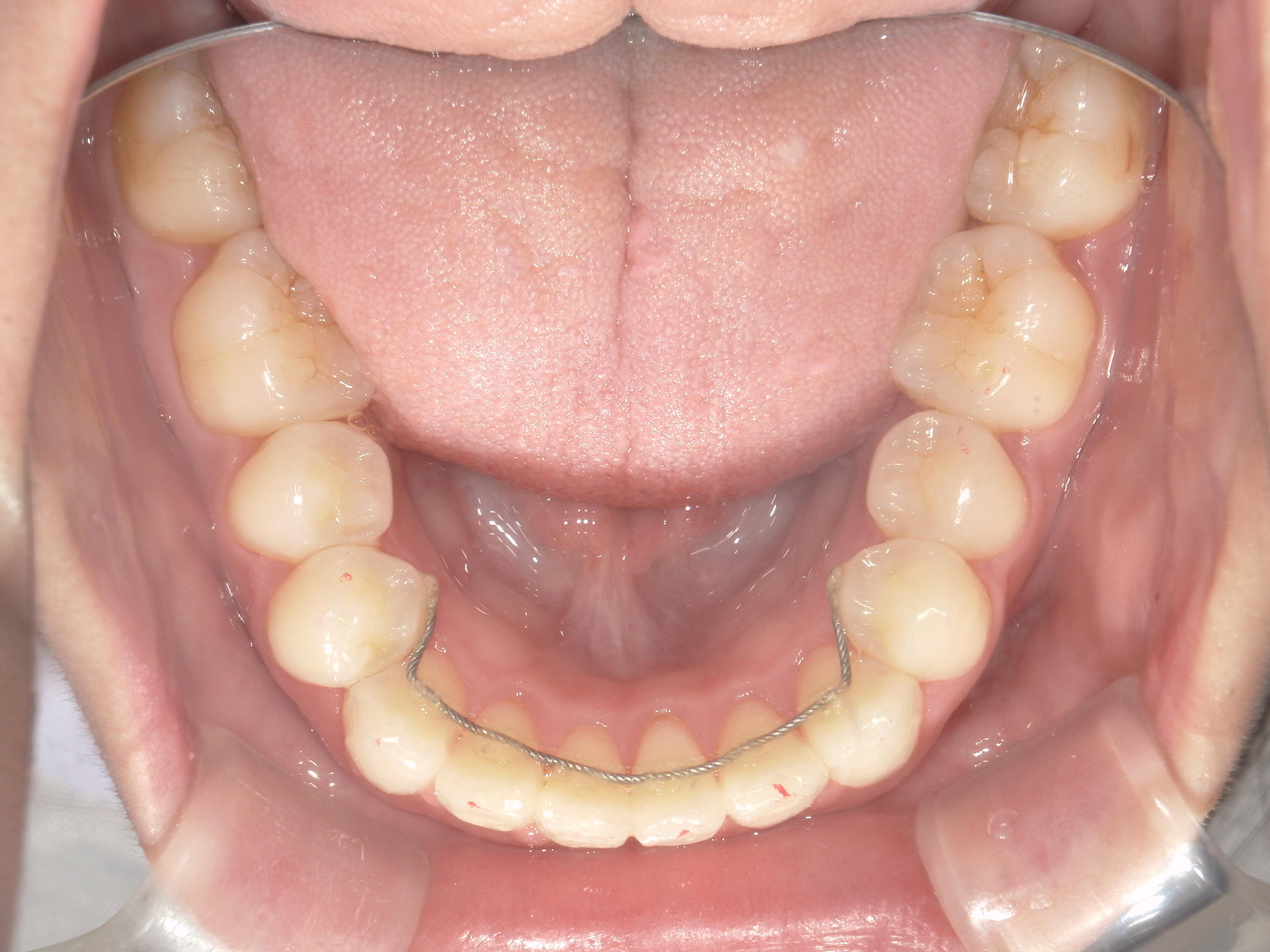 プチワイヤー矯正　症例（60）