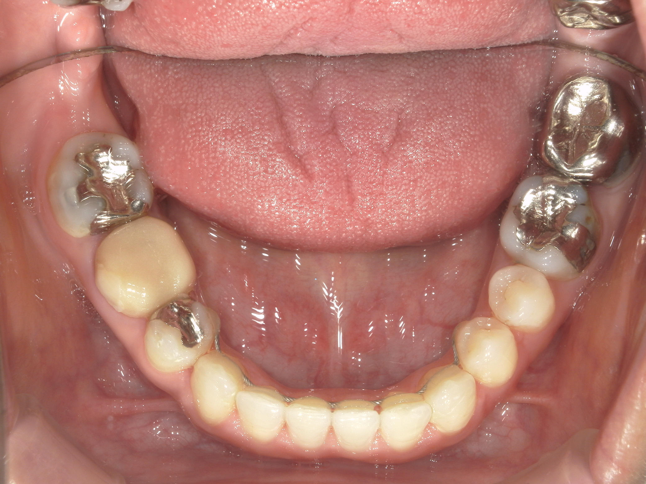 インビザライン矯正　症例（30）