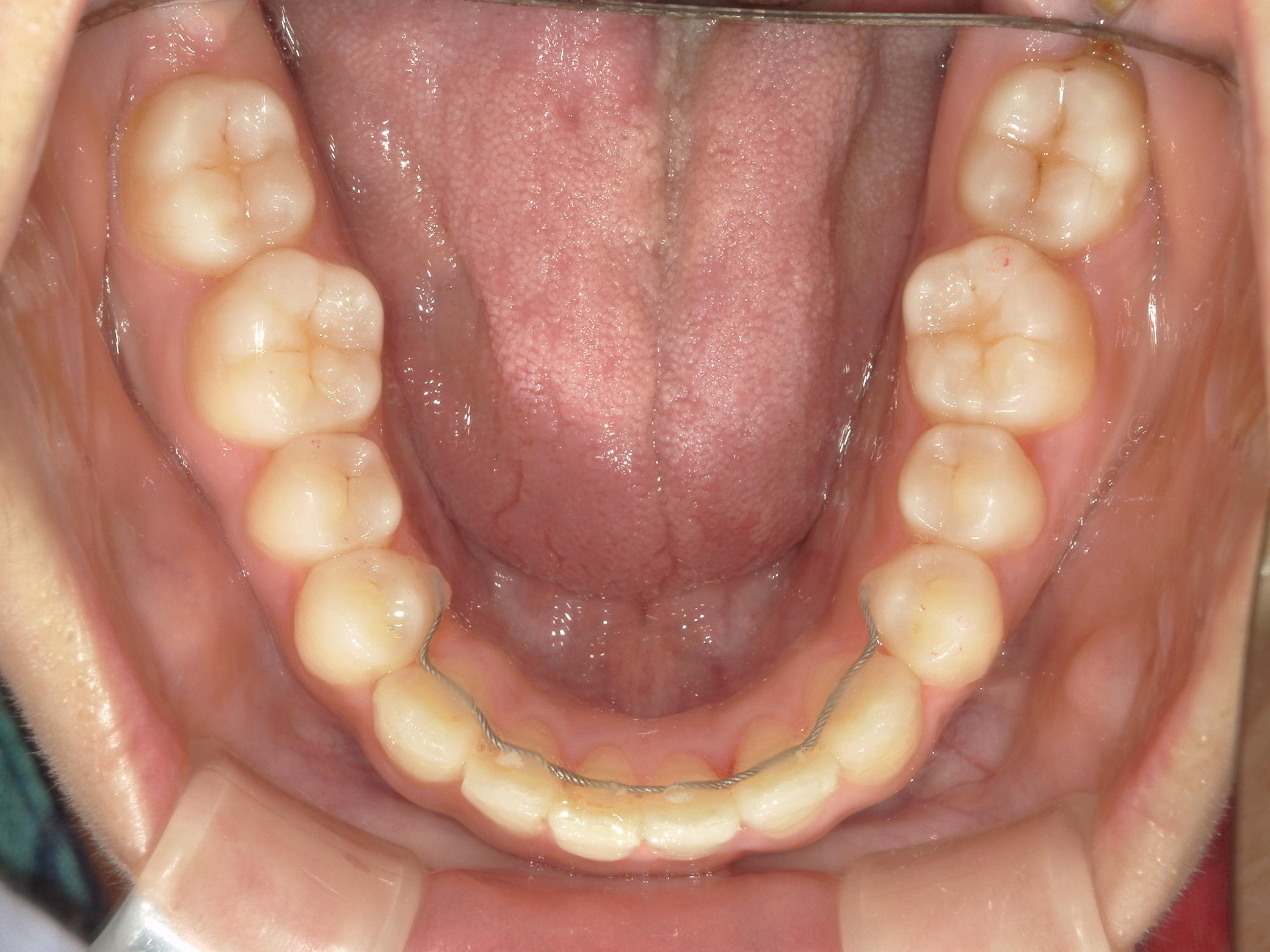 インビザライン(ライト)矯正　症例（31）