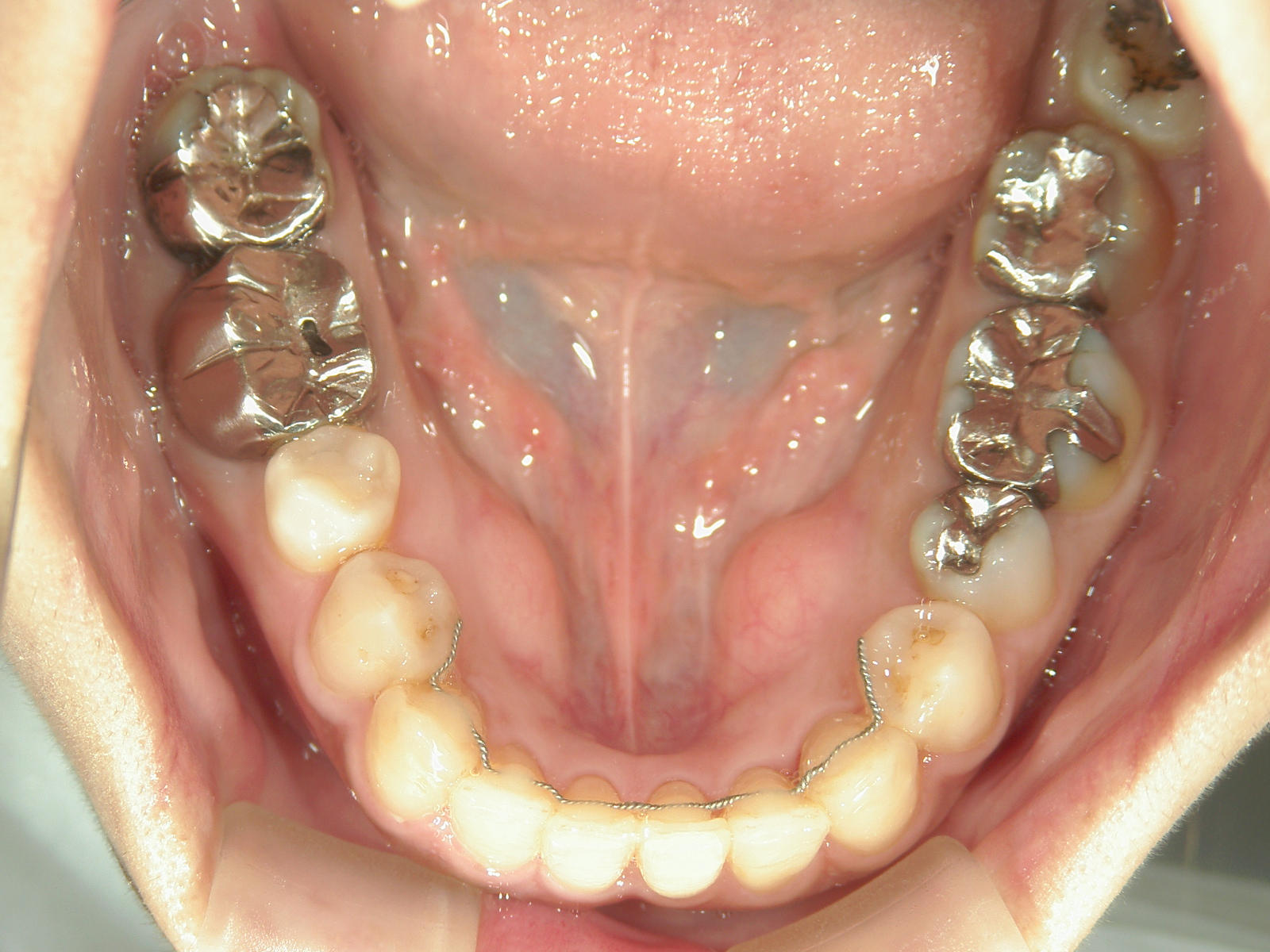 プチワイヤー矯正　症例（59）