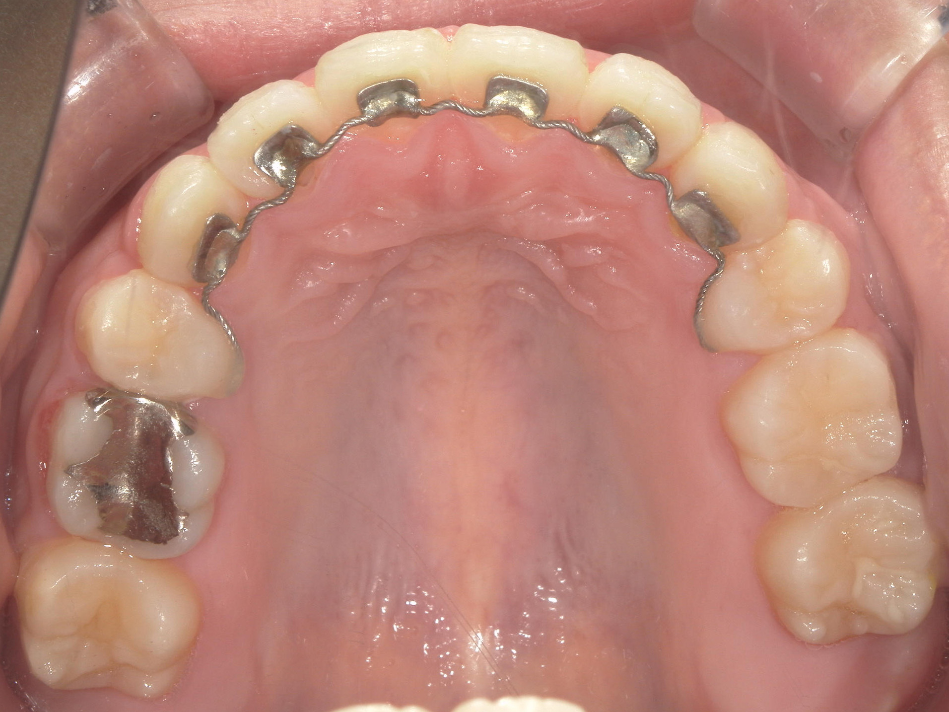 全顎ワイヤー矯正　症例（80）